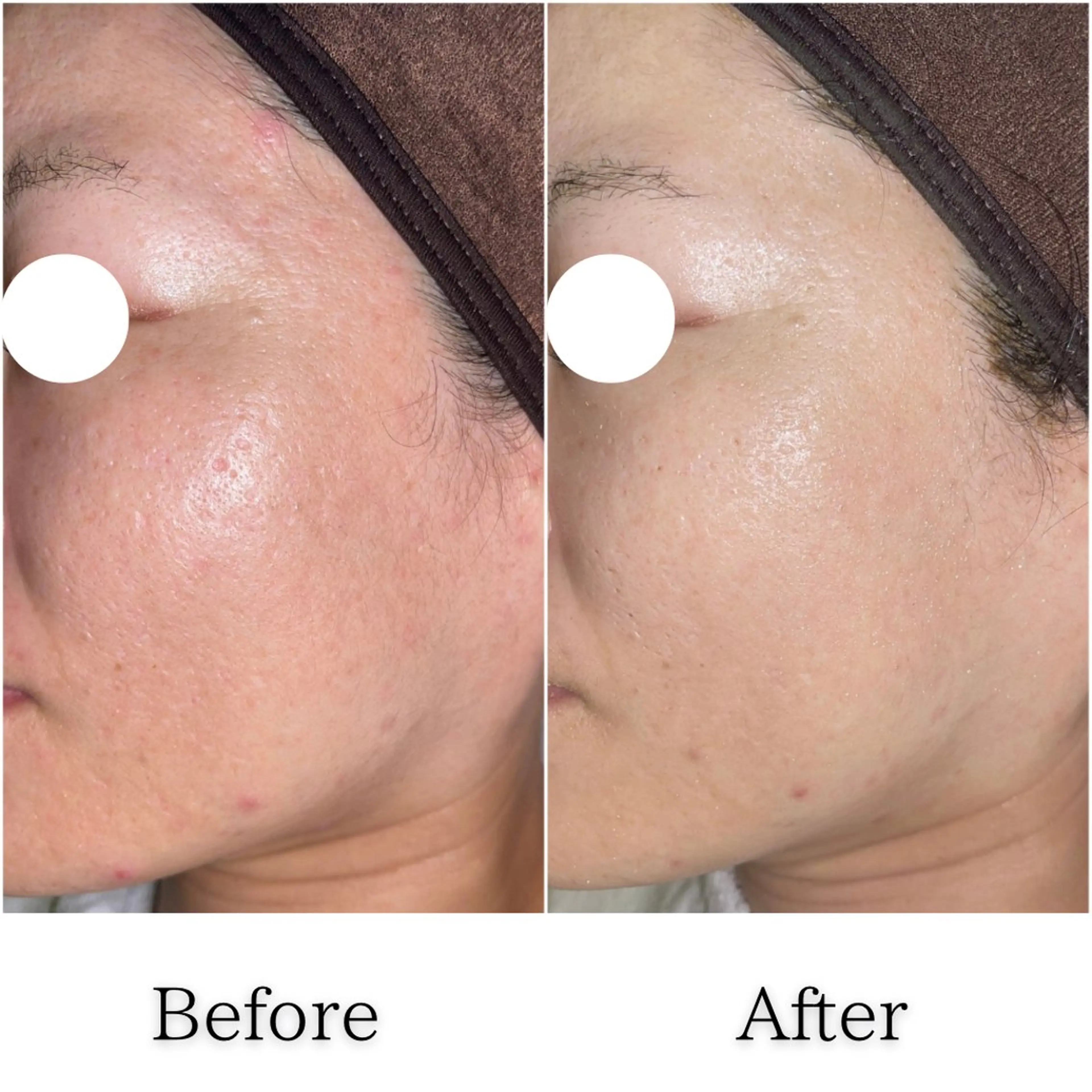 【次世代ハーブピーリング】※男女OKの写真