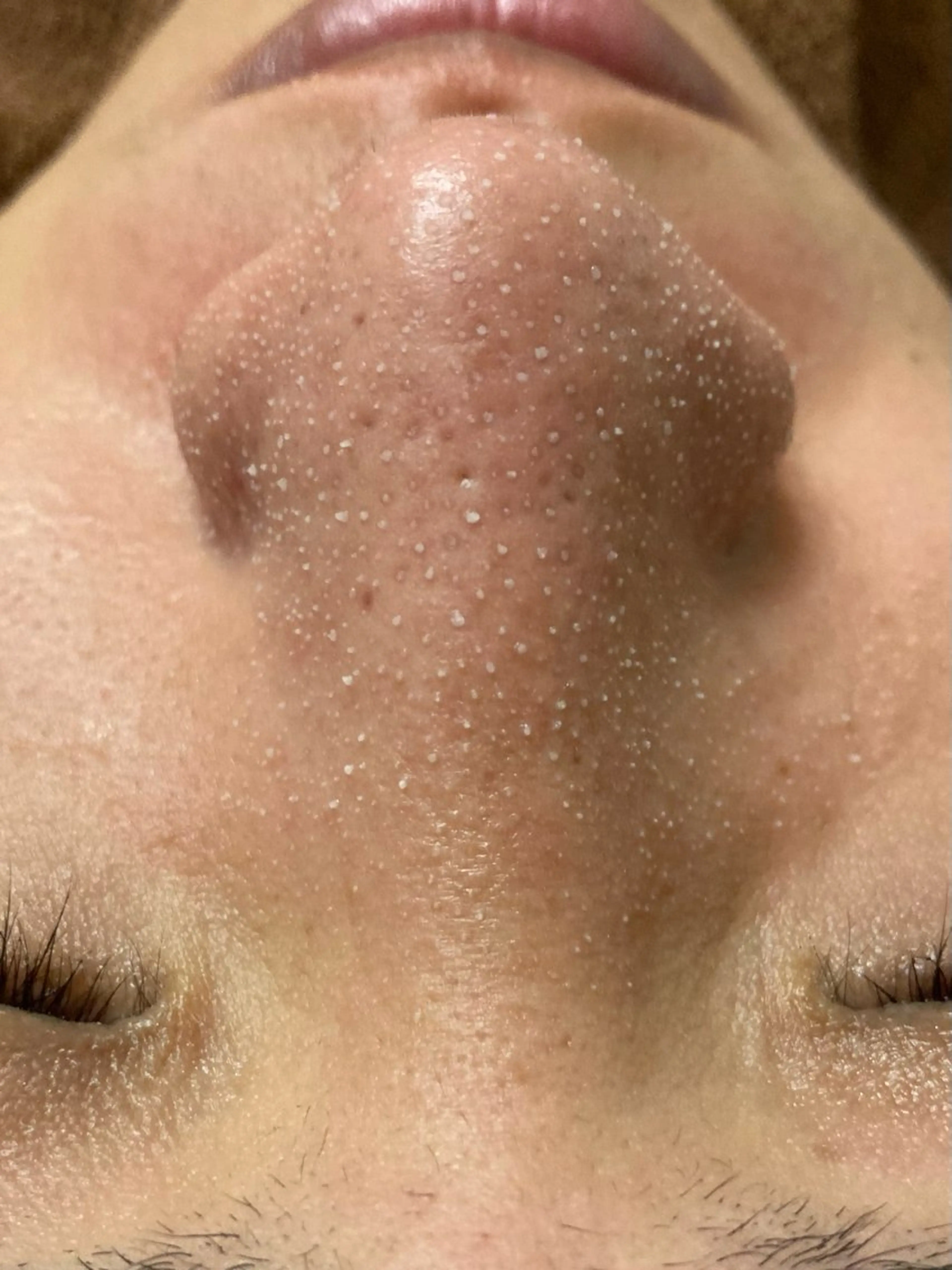 【人気No1】横浜初！SNS話題の最新毛穴洗浄！角栓が浮き出る【韓国式3D毛穴洗浄】極上のたまご肌へ！全顔70分の写真