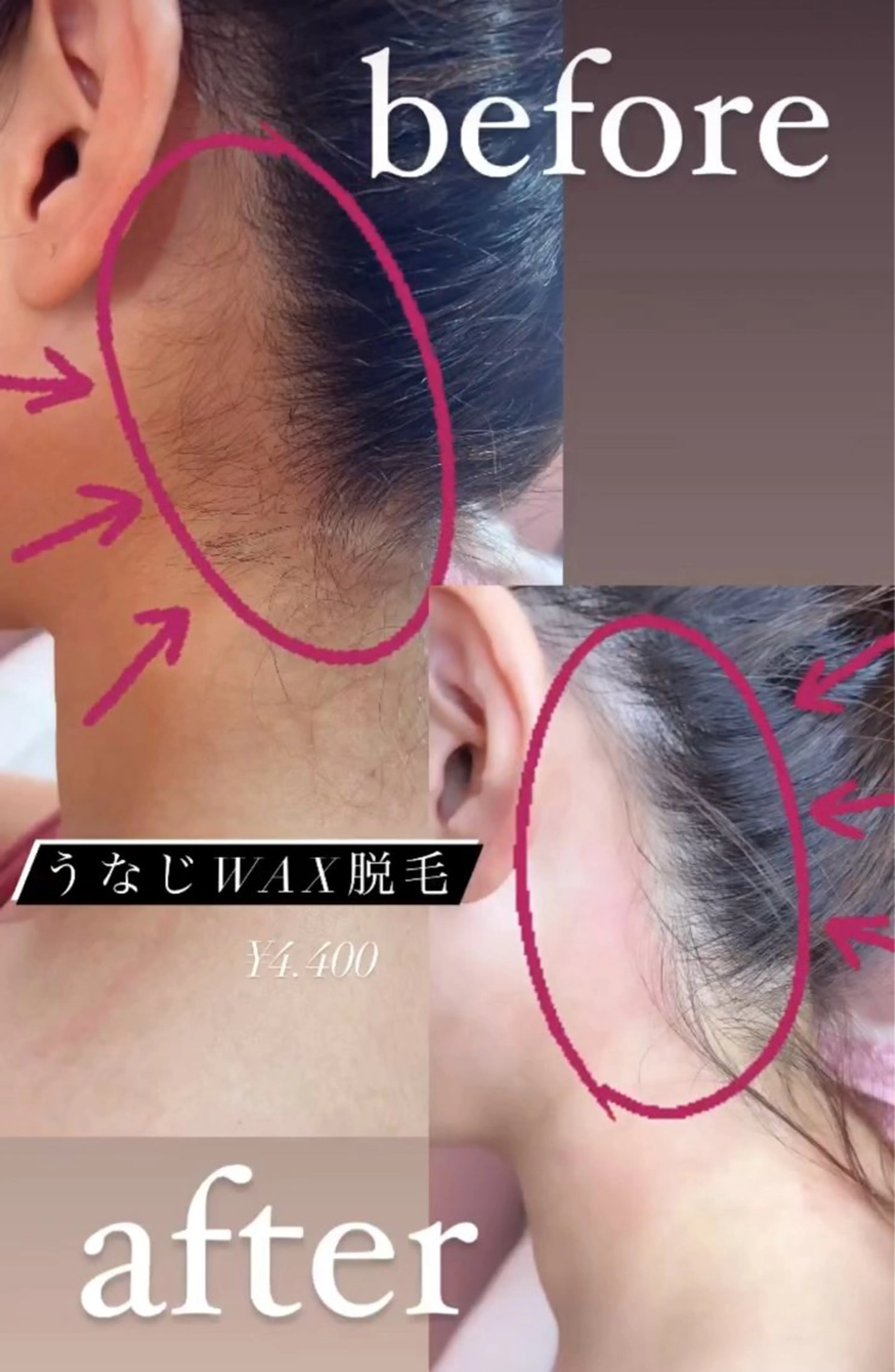 モサモサうなじワックス脱毛の写真