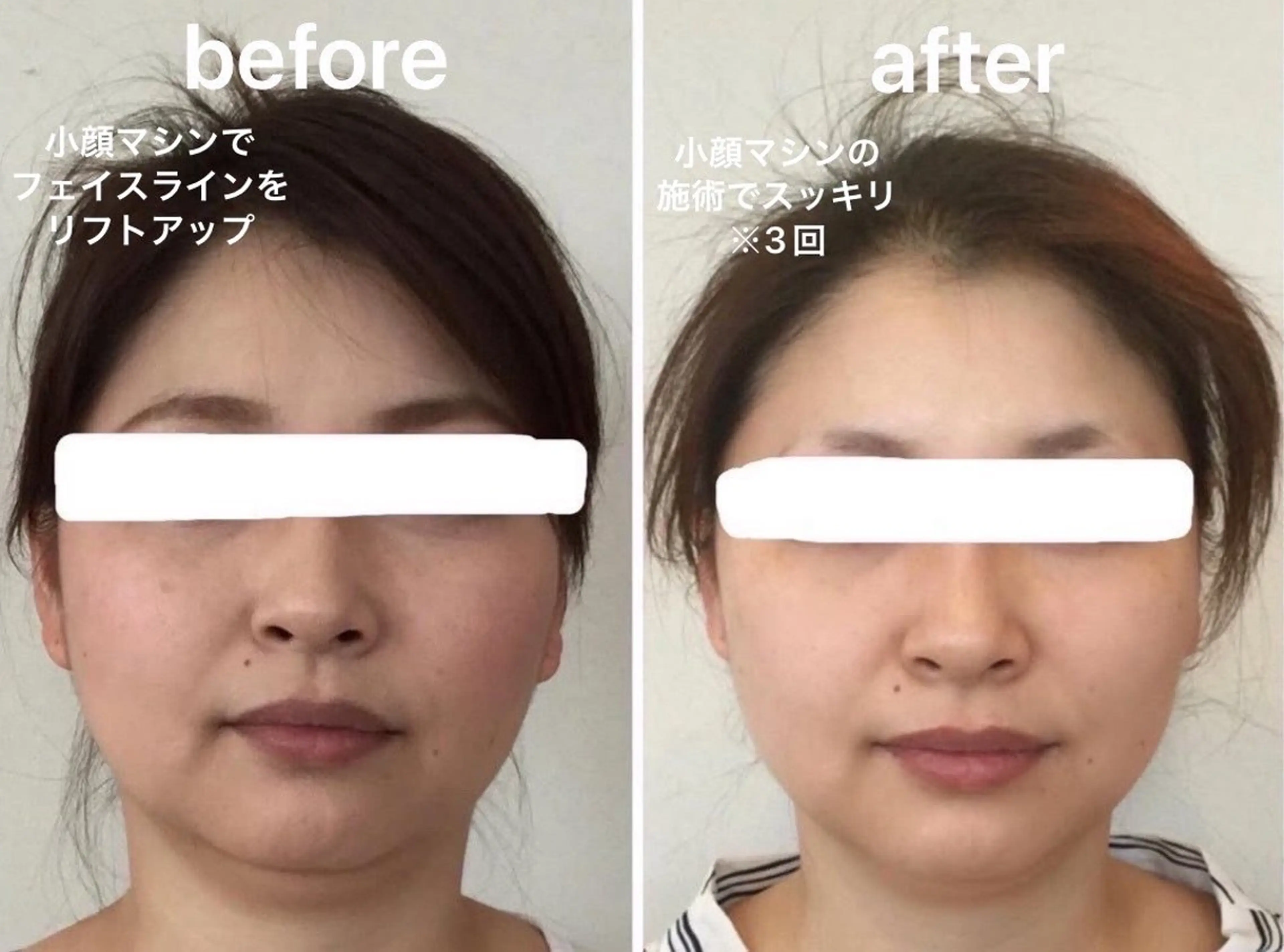 オリジナル小顔マシン⭐5000ショット⭐人気メニュー♪の写真