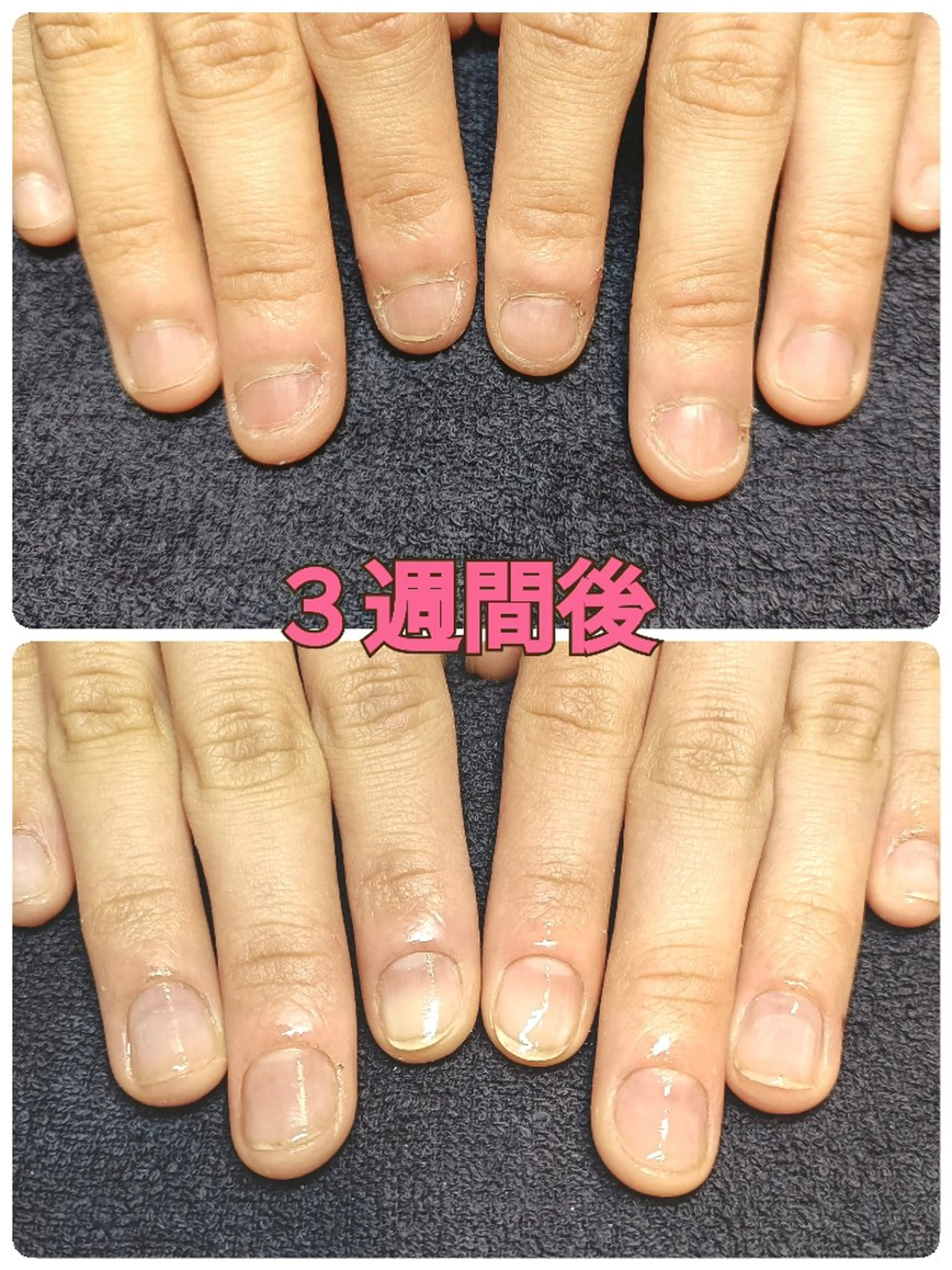 ネイル ハンドネイル ハンドケア 深爪矯正/爪育成ケア manie nailのネイルデザイン