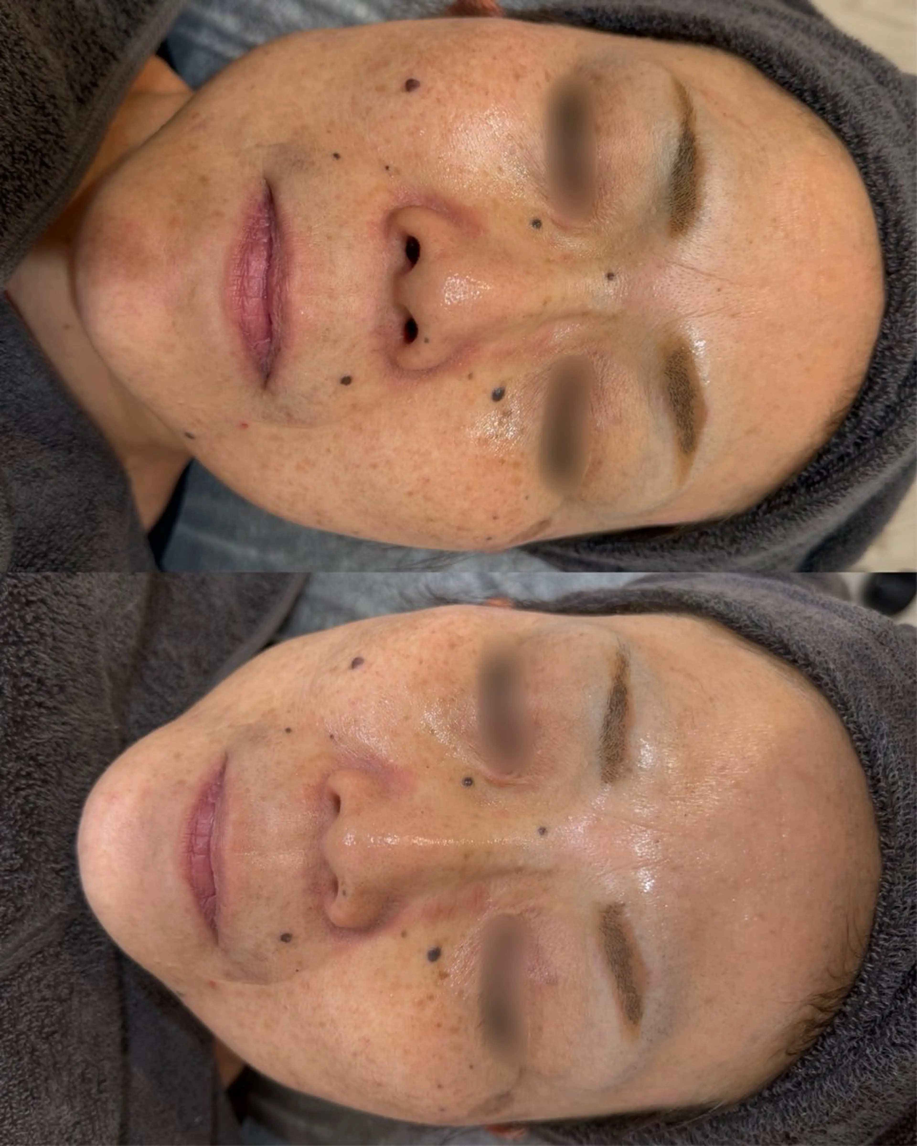 メンズ 植物幹細胞ピーリング |肌質改善専門サロンのエステ・リラクイメージ