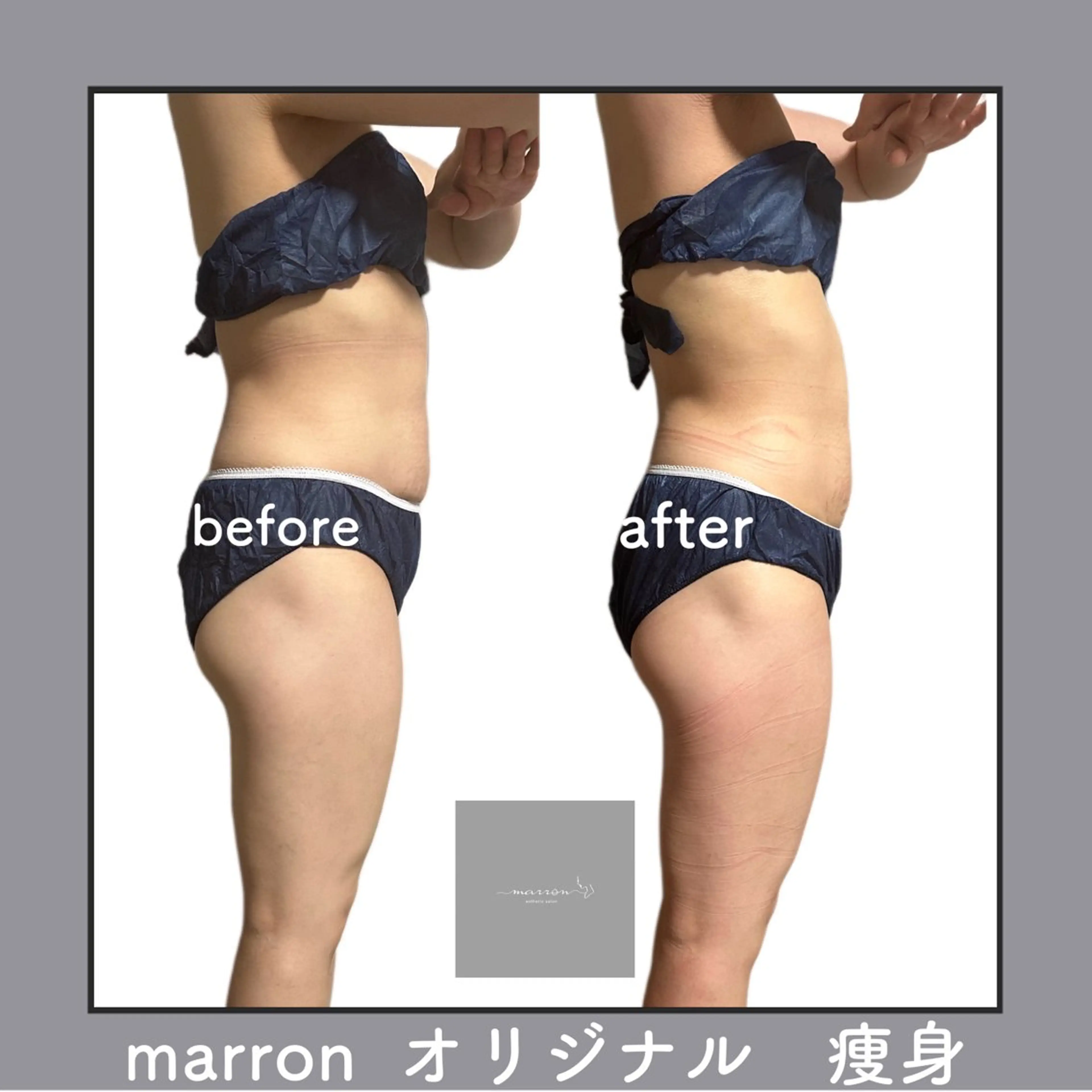 痩身ハイパーナイフ ララピールリアボーテのエステ・リラクイメージ