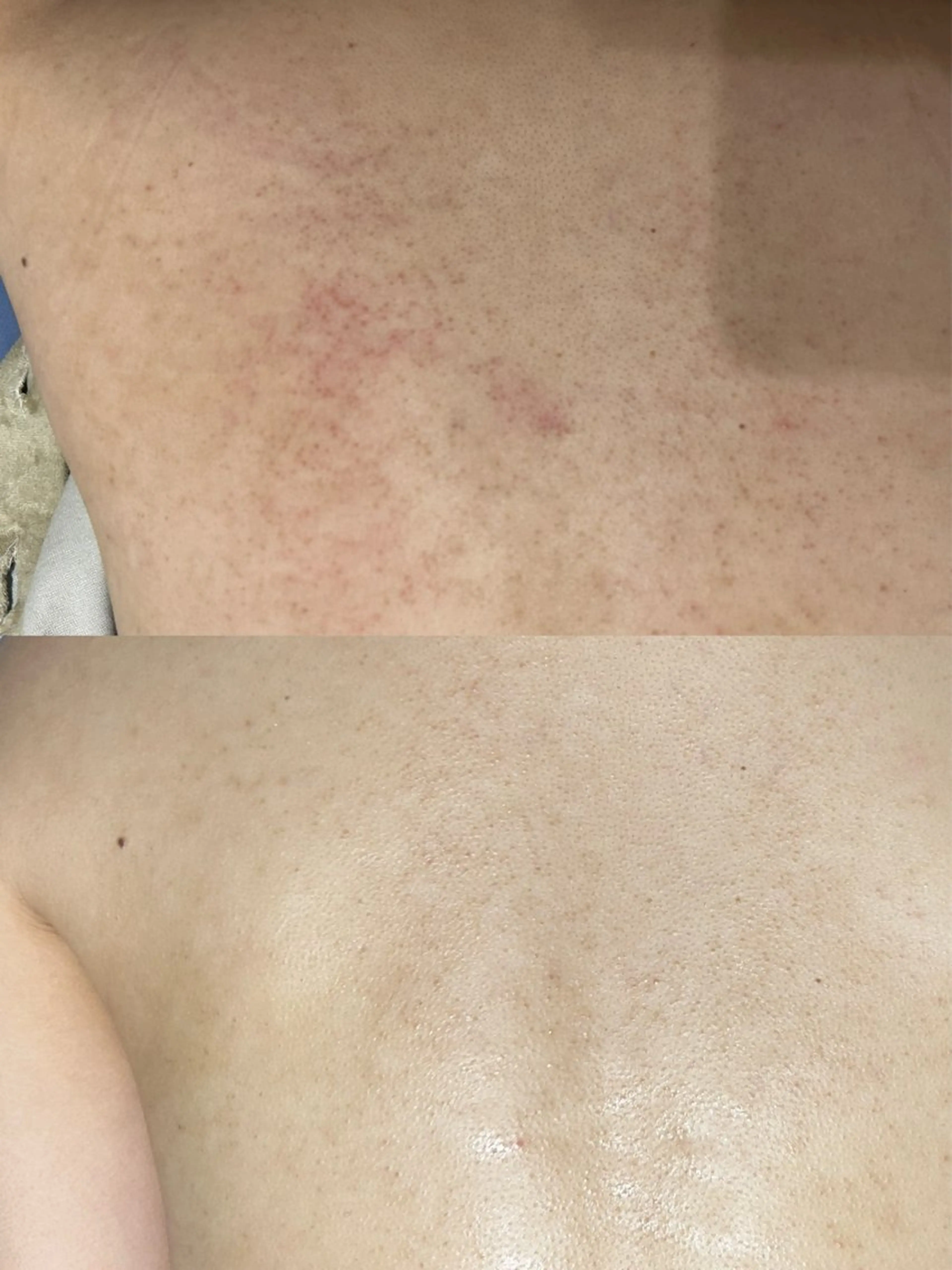 【女性限定💖】背中のハーブピーリング🌿の写真