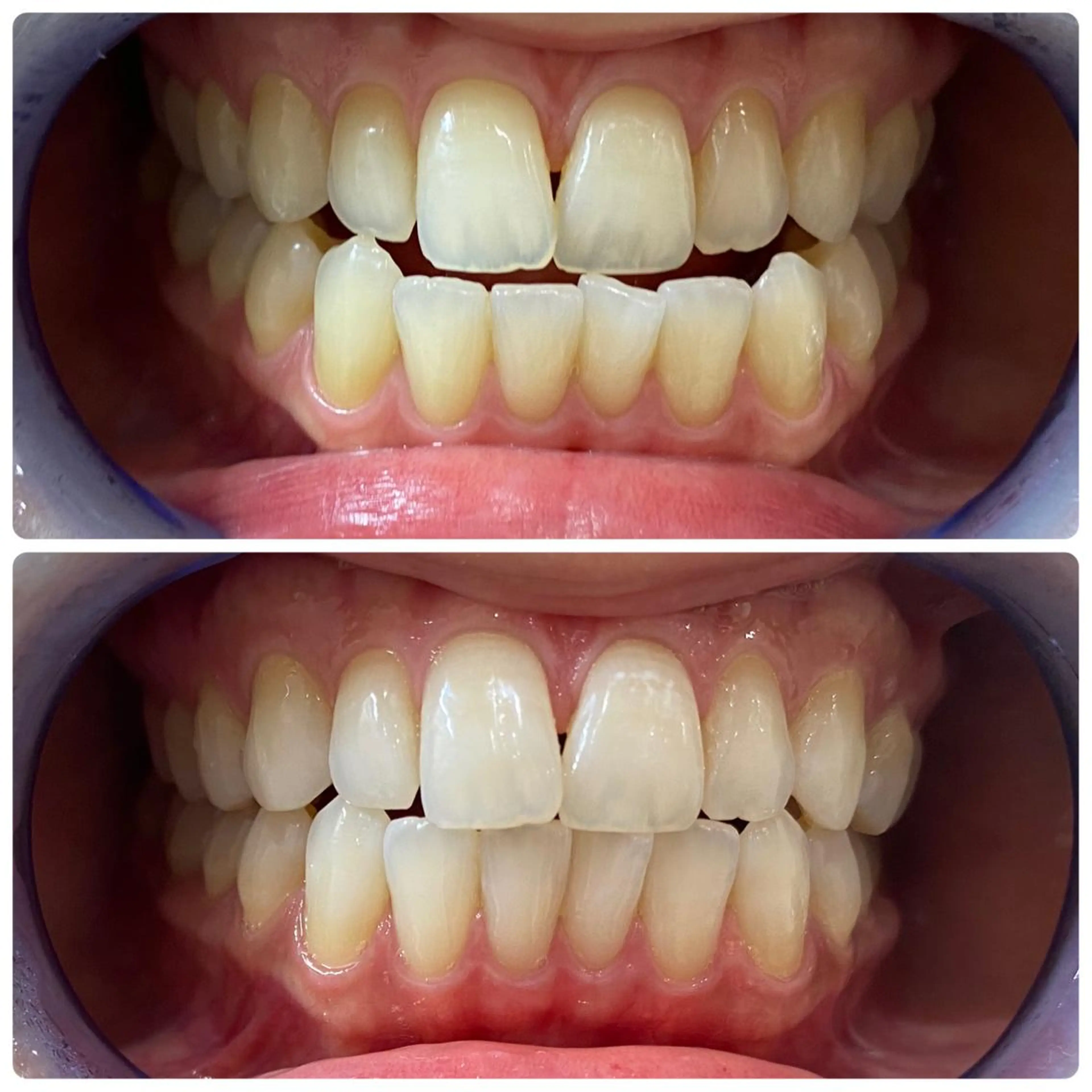 その他 セルフホワイトニング 🦷口元垢抜け✨のその他イメージ