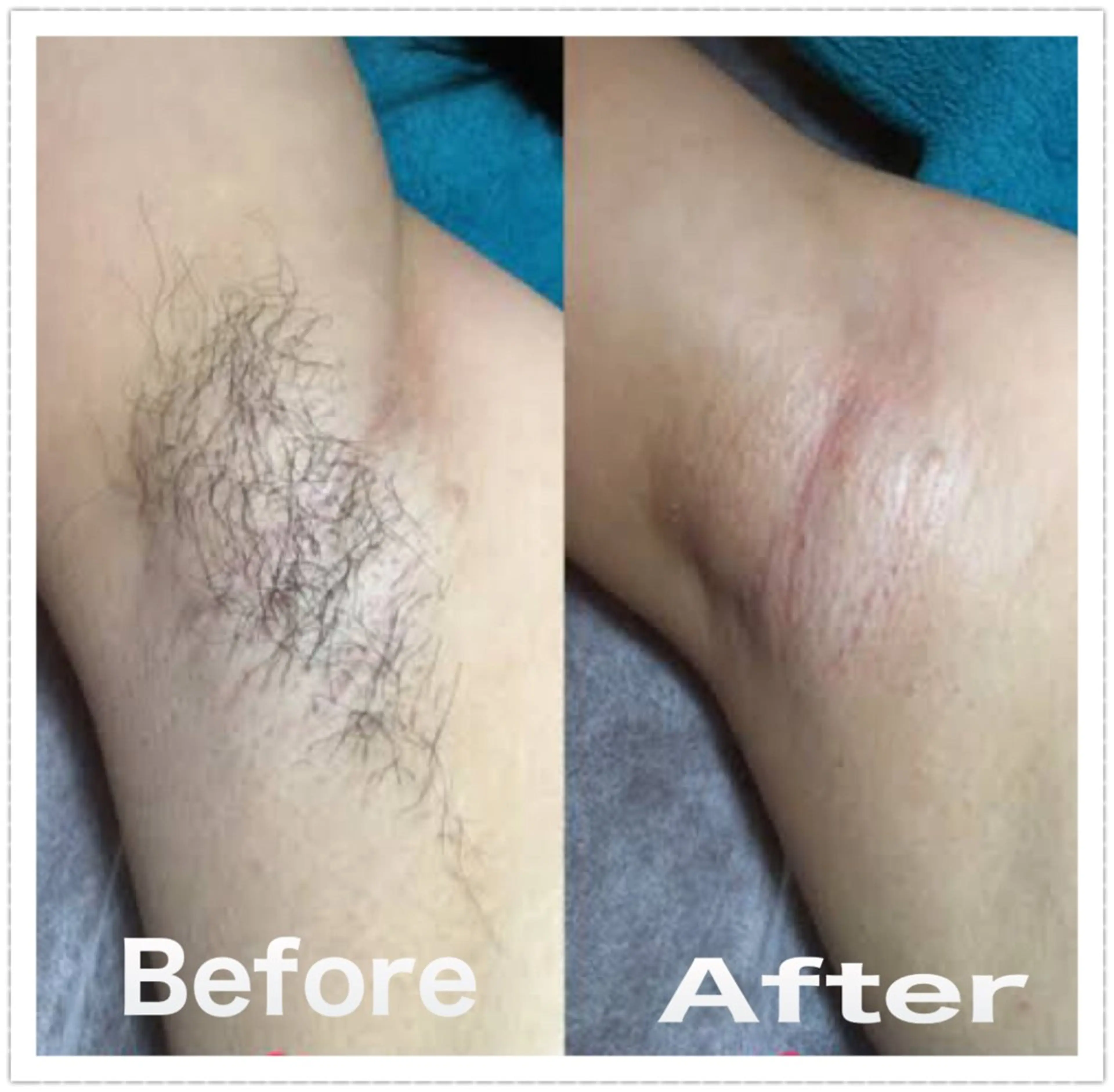 🟣脱毛🟣《ワキ》ワキの黒ずみ大丈夫?ワックス脱毛☆4400円 女性限定！ワキ毛は最低5ミリないと施術できませんの写真