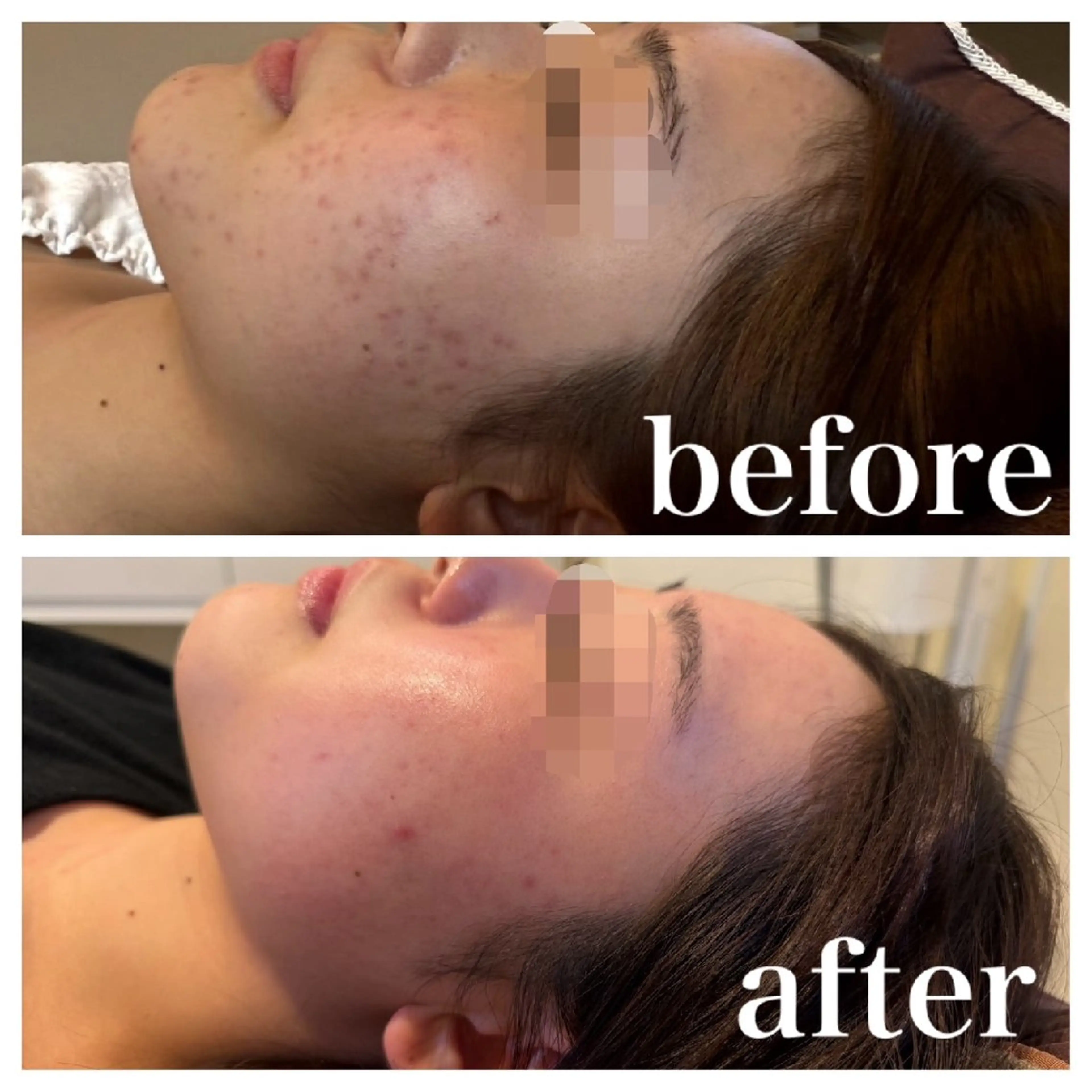 その他 医療提携Ruby所属・医療提携Ruby小顔 ハーブピーリングのその他イメージ