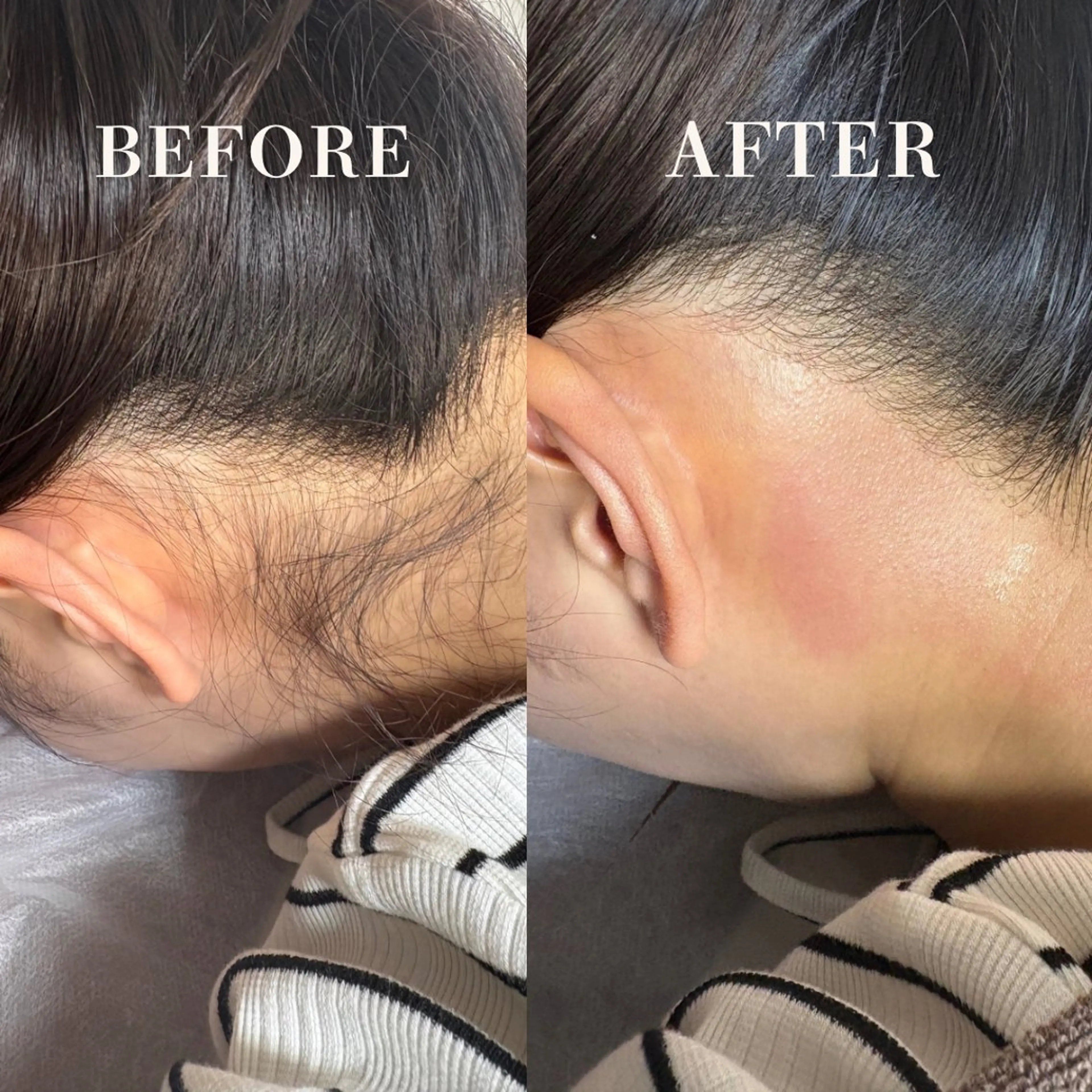 うなじワックス+うなじ光脱毛(ワックス+光脱毛)の写真