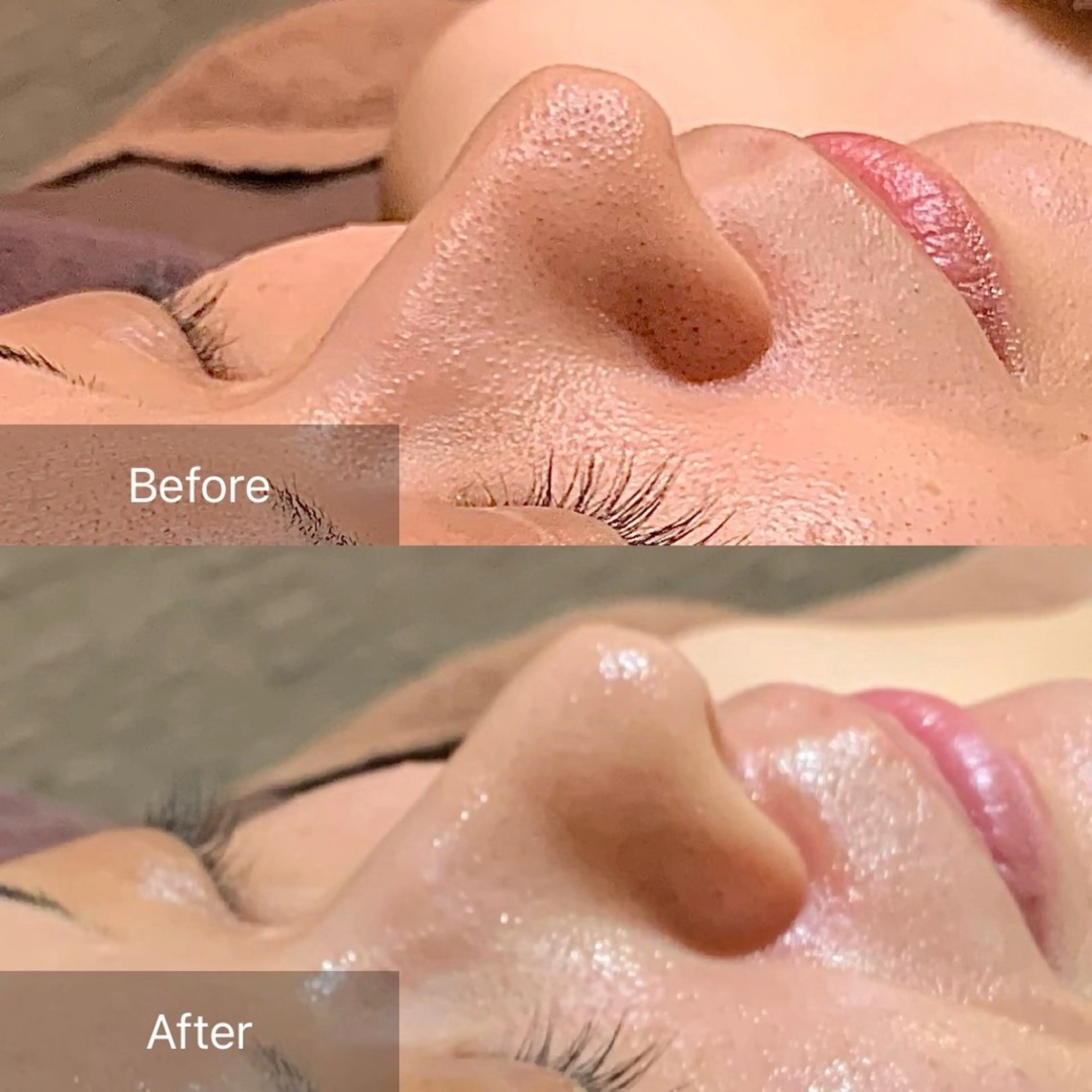 脱毛 渋谷ベルゼ🌷木下 毛穴/脱毛/フェムのその他イメージ