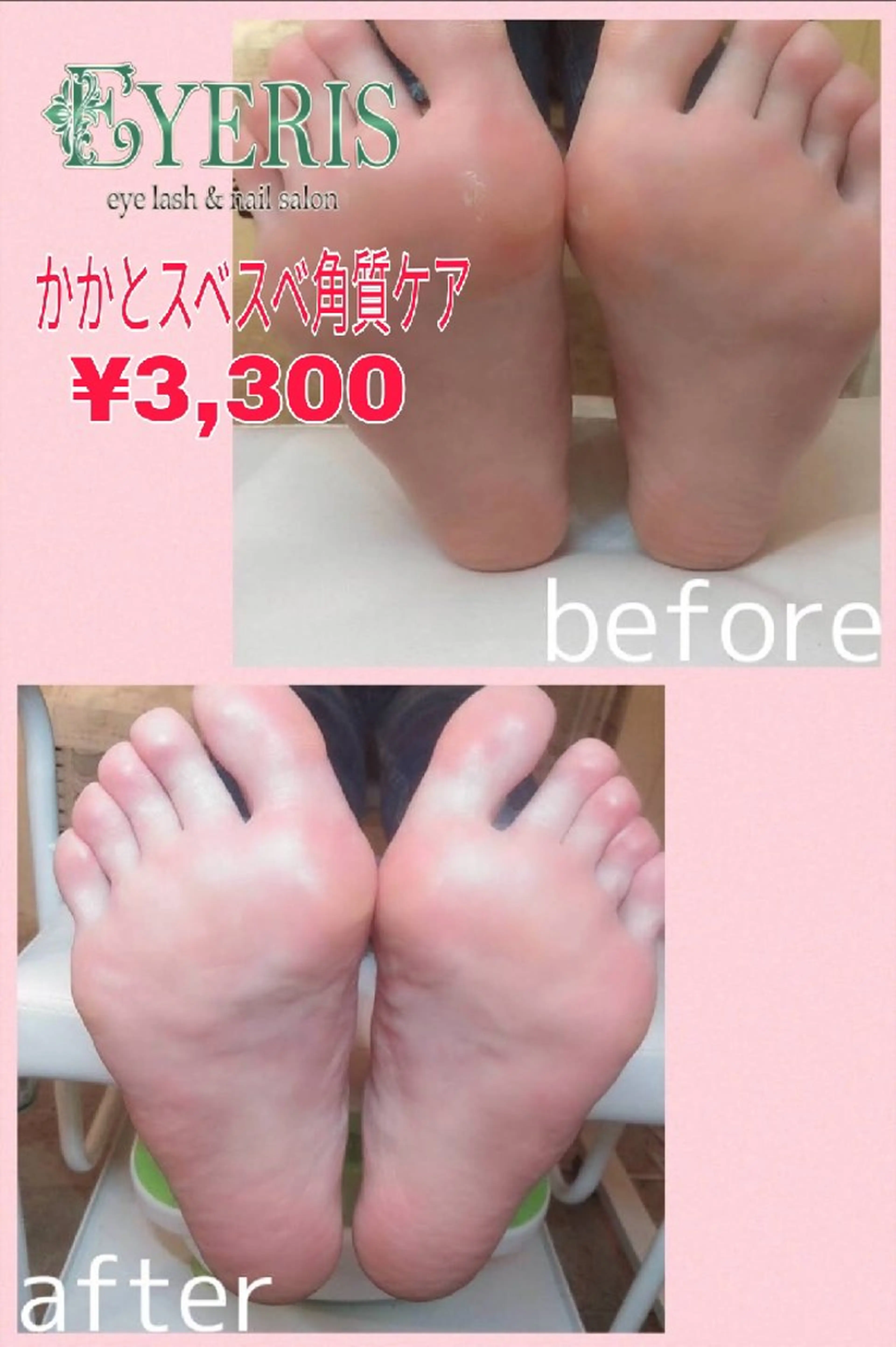 かかと角質ケアの写真