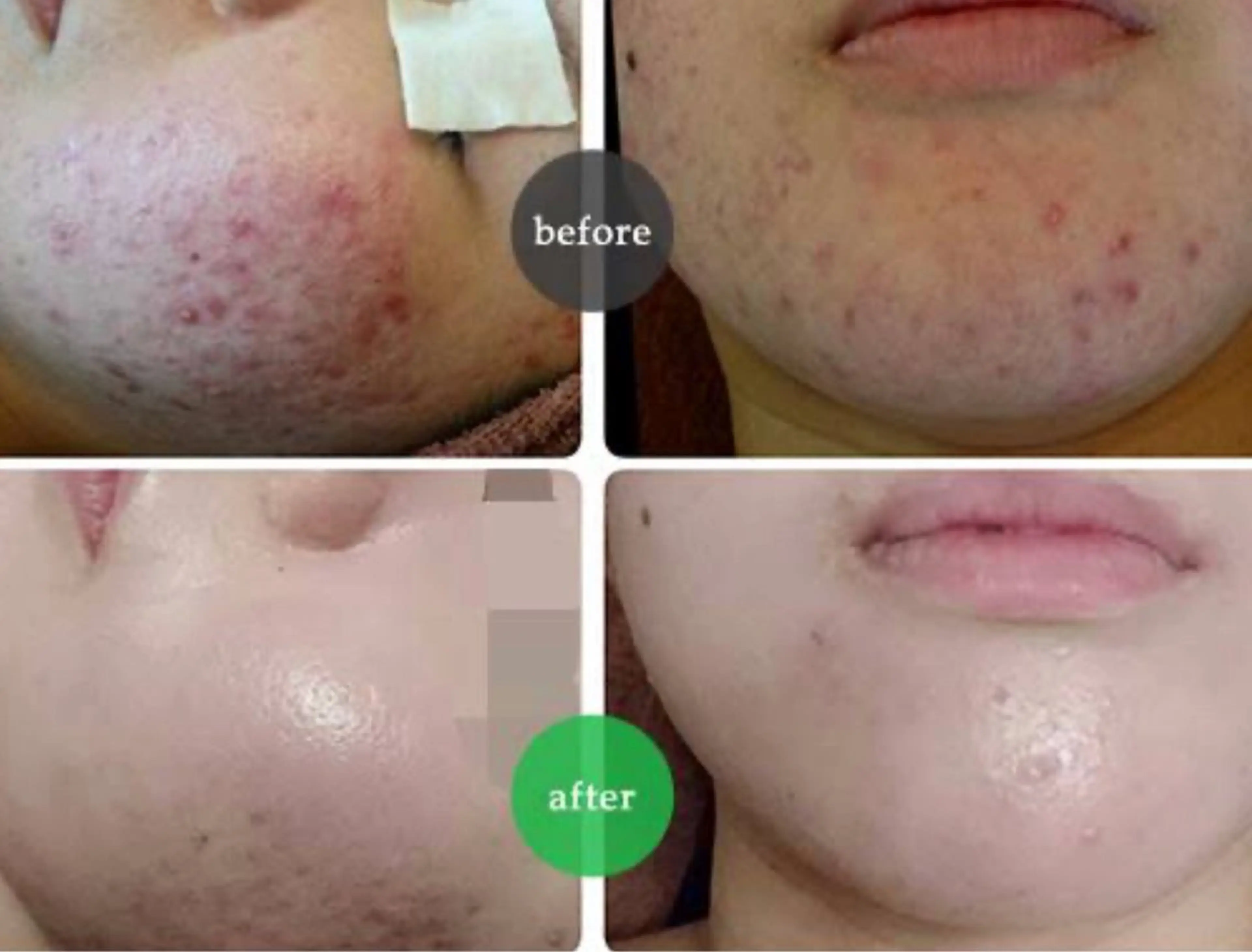 エステ ☺ハーブピール💕 ソフィアカロン💖のエステ・リラクイメージ