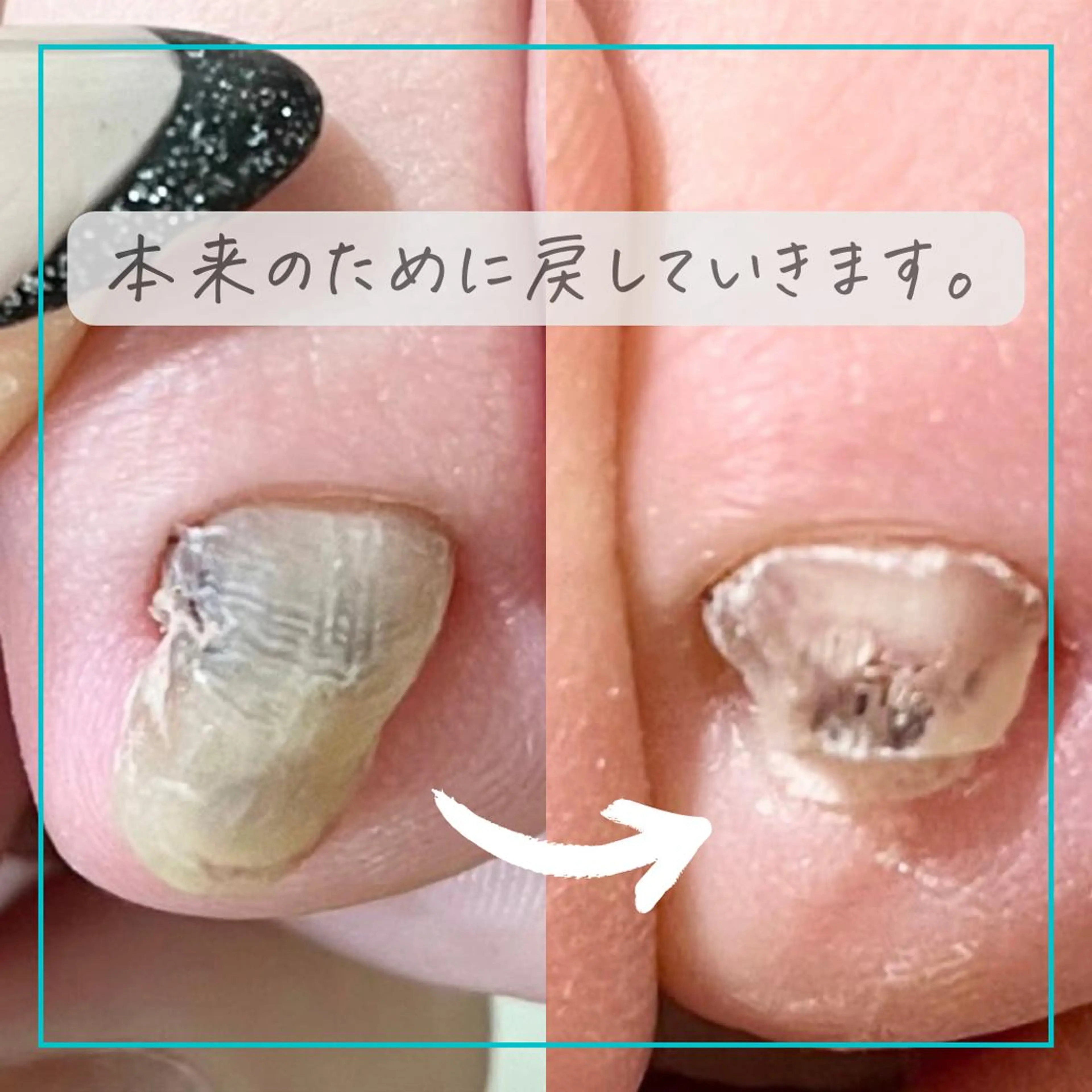 ネイル 深爪・巻き爪 専門サンセリテのネイルデザイン