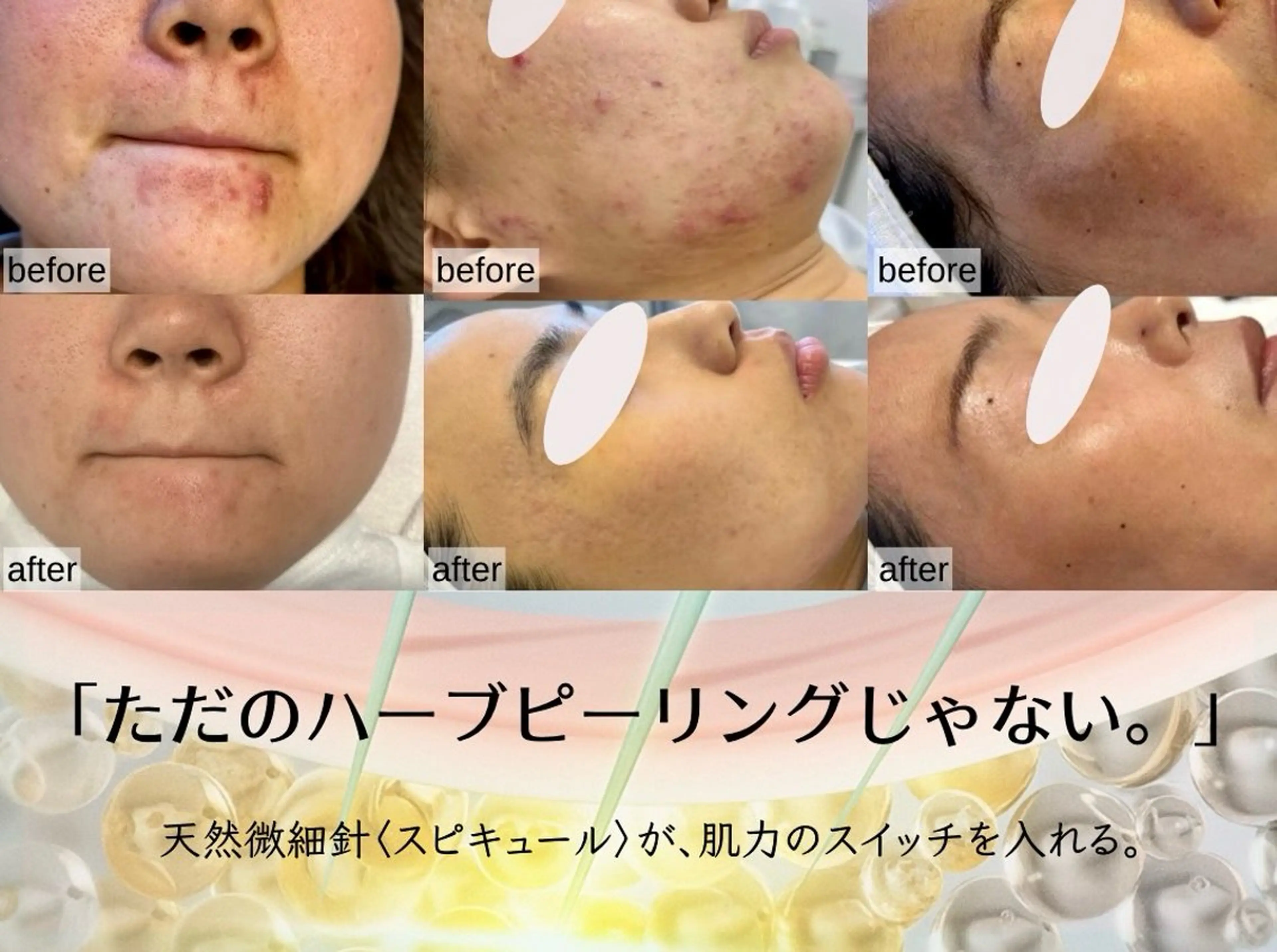 毛穴・くすみ・ざらつきに✨ワントーン明るい肌へ☺️剥けないハーブピーリング🌿濃度10​〜​50%❣️の写真