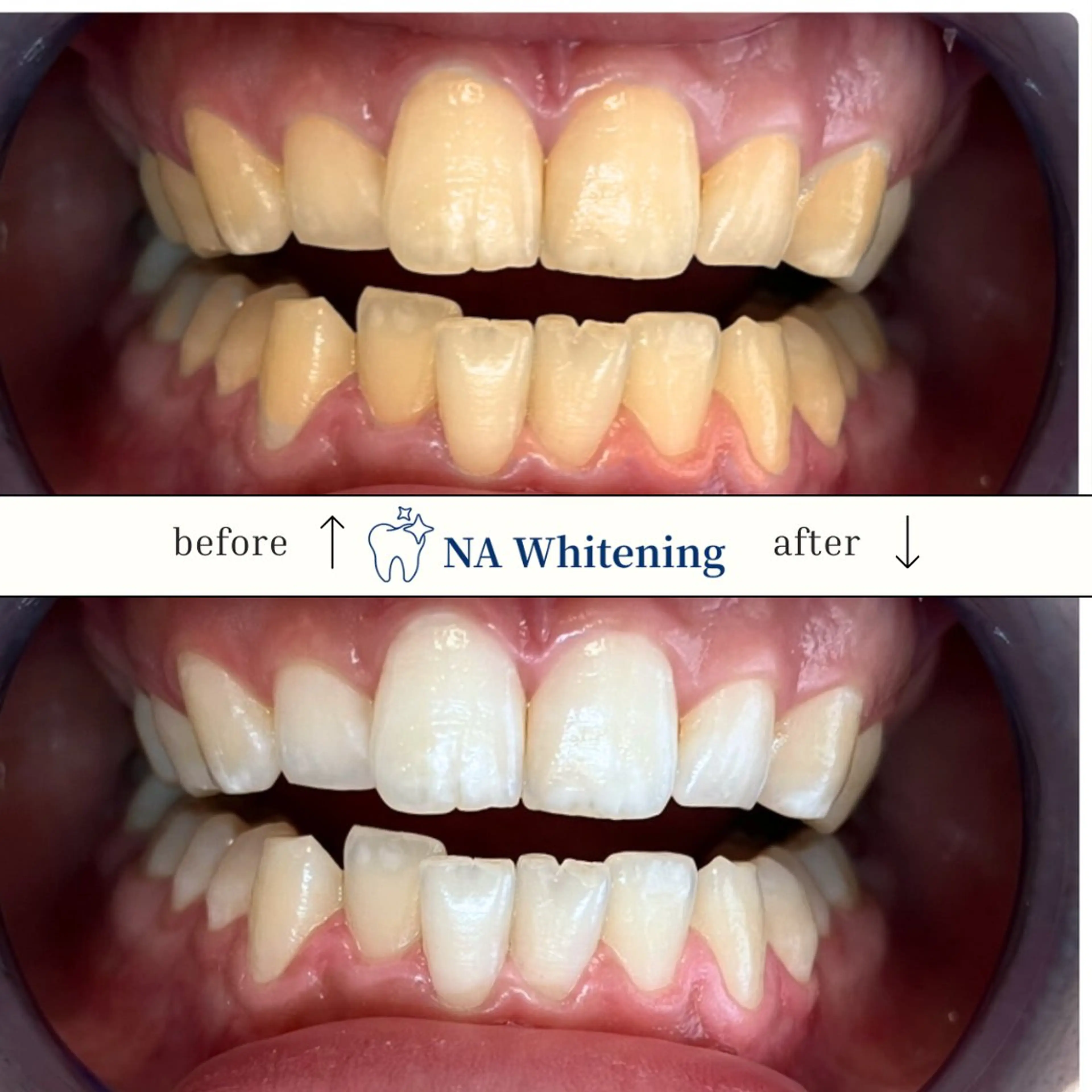 【イベント前に！】ホワイトニング3回コース¥23,940→18,700 短期集中プラン！の写真