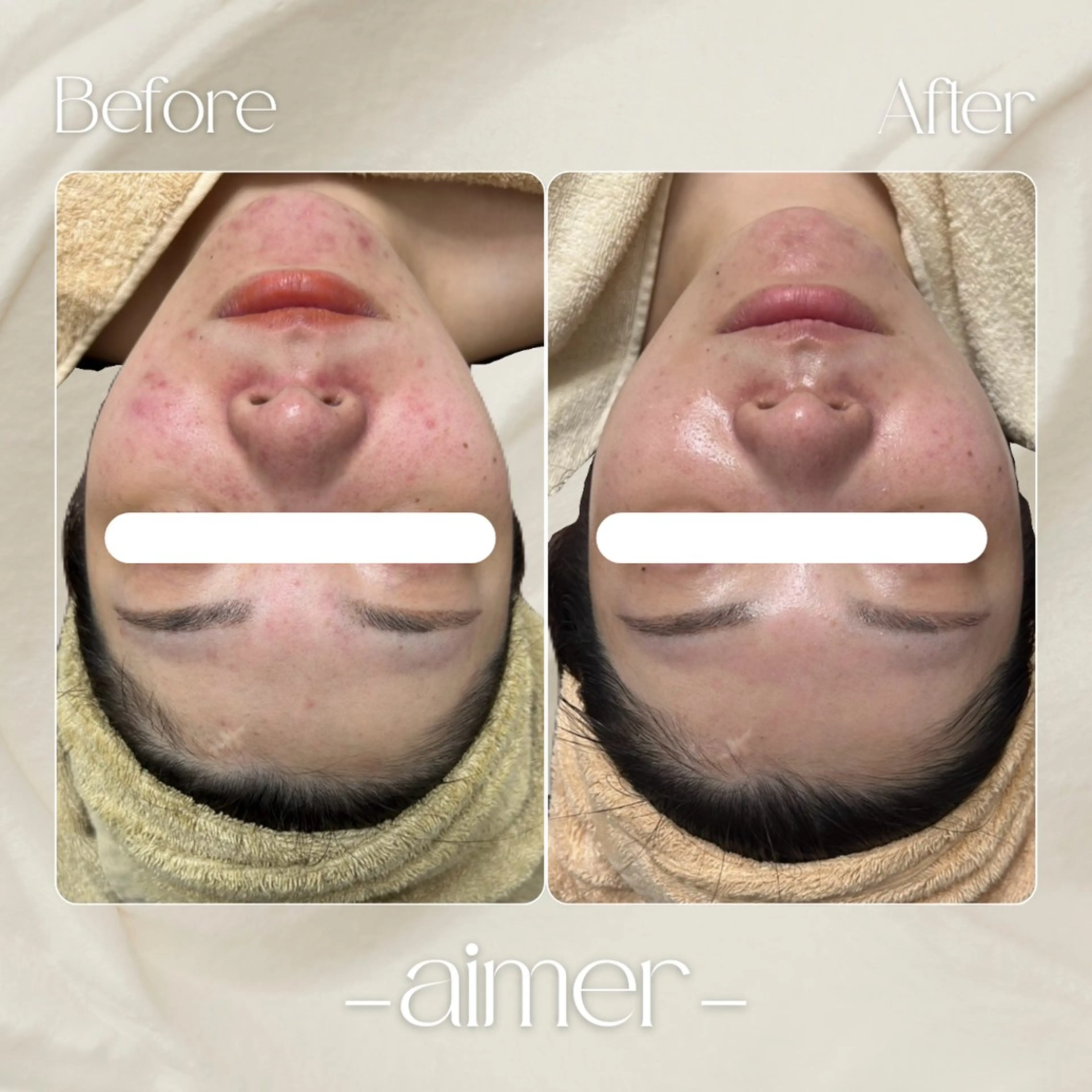 プラズマ+水玉リフティング｜たるみ・毛穴の開き お悩みの方必見👀の写真