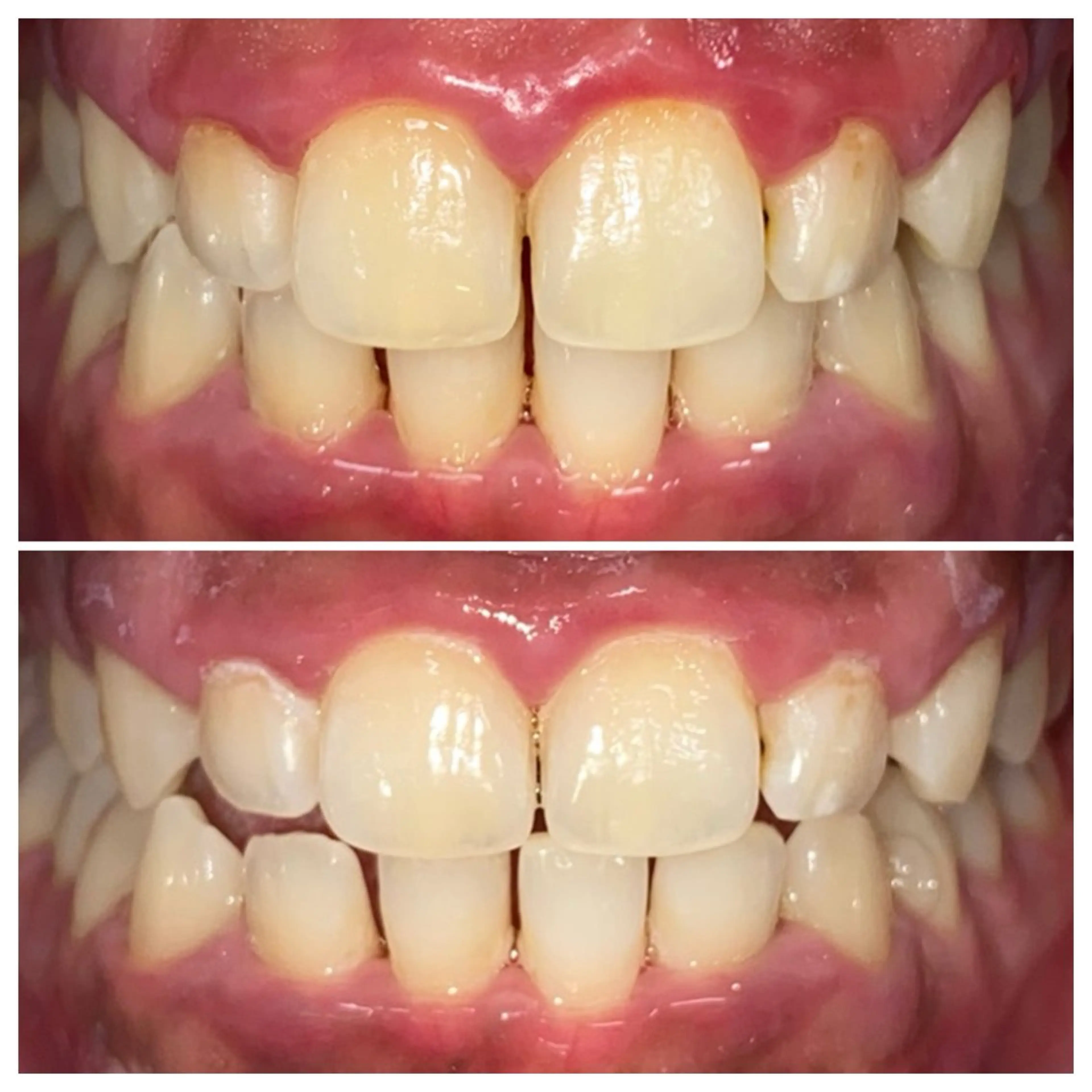 その他 ルミナホワイト セルフホワイトニングのその他イメージ