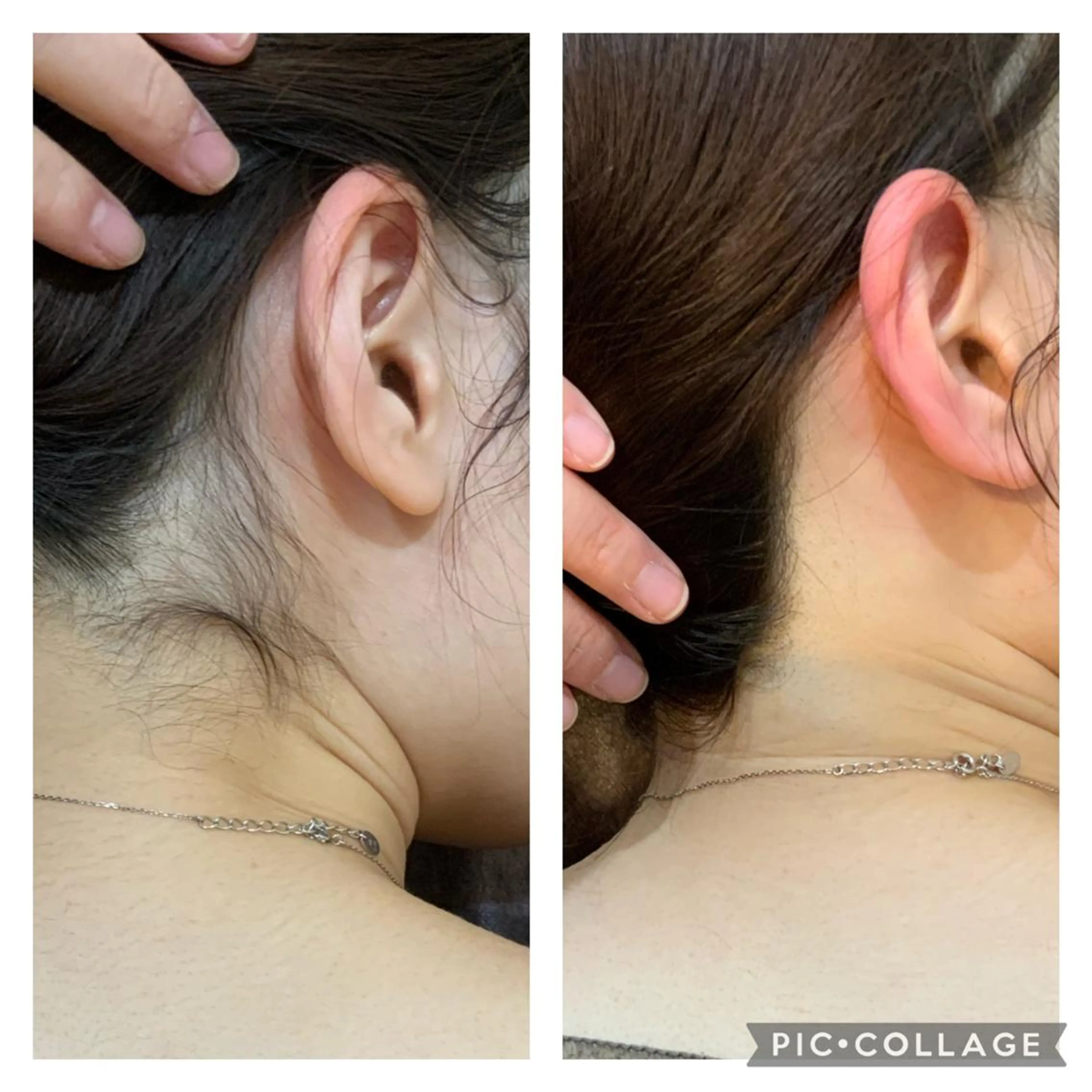 【期間限定】背中•うなじ通常8.250円⇨2.750円の写真