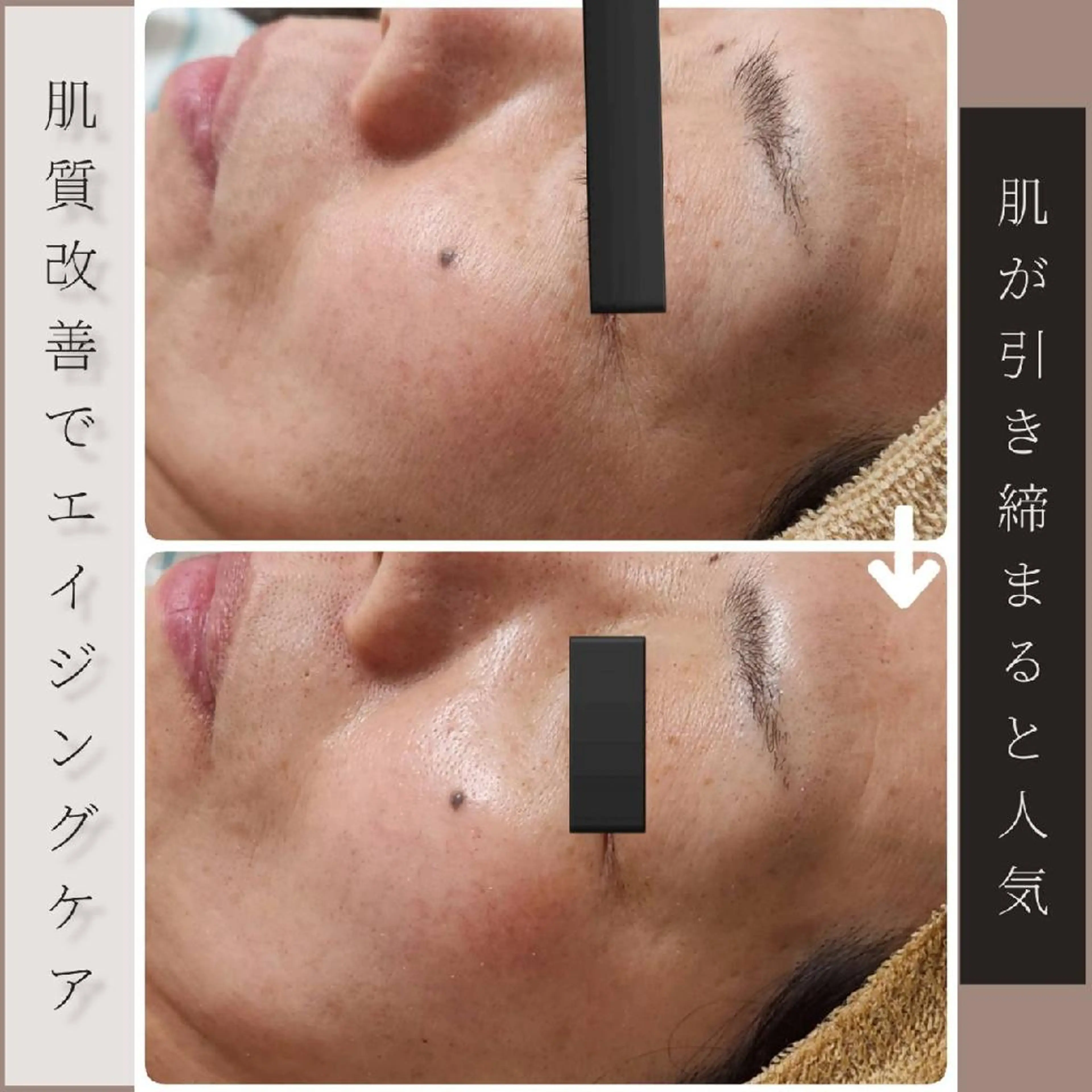 【乾燥/赤み/むくみ/シワ改善/ニキビケア】ハーブピーリング+ポレーションの写真