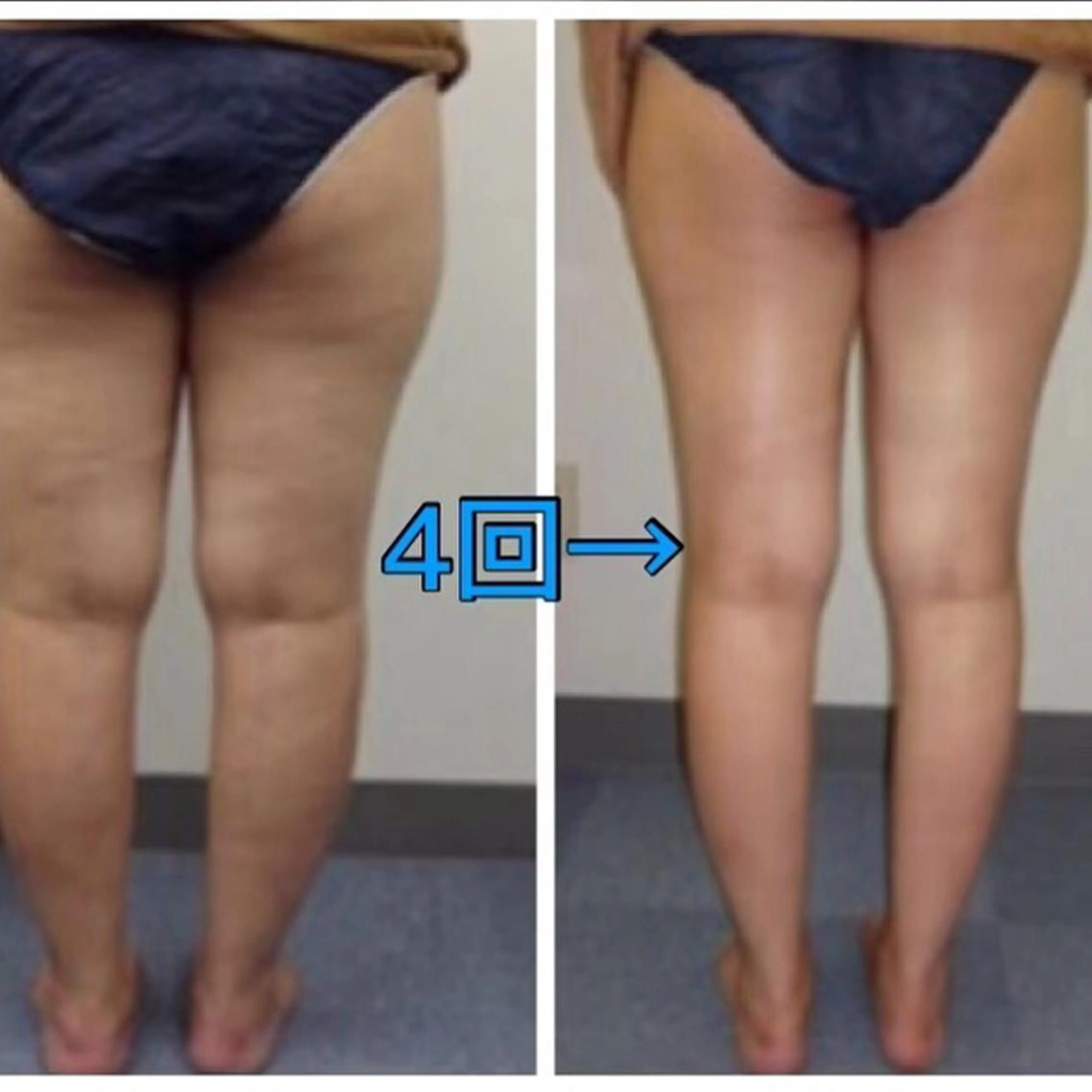 🌈特別限定🌈ハイパーナイフ＋全身アロマリンパ＋ドライヘッドスパ120分の写真