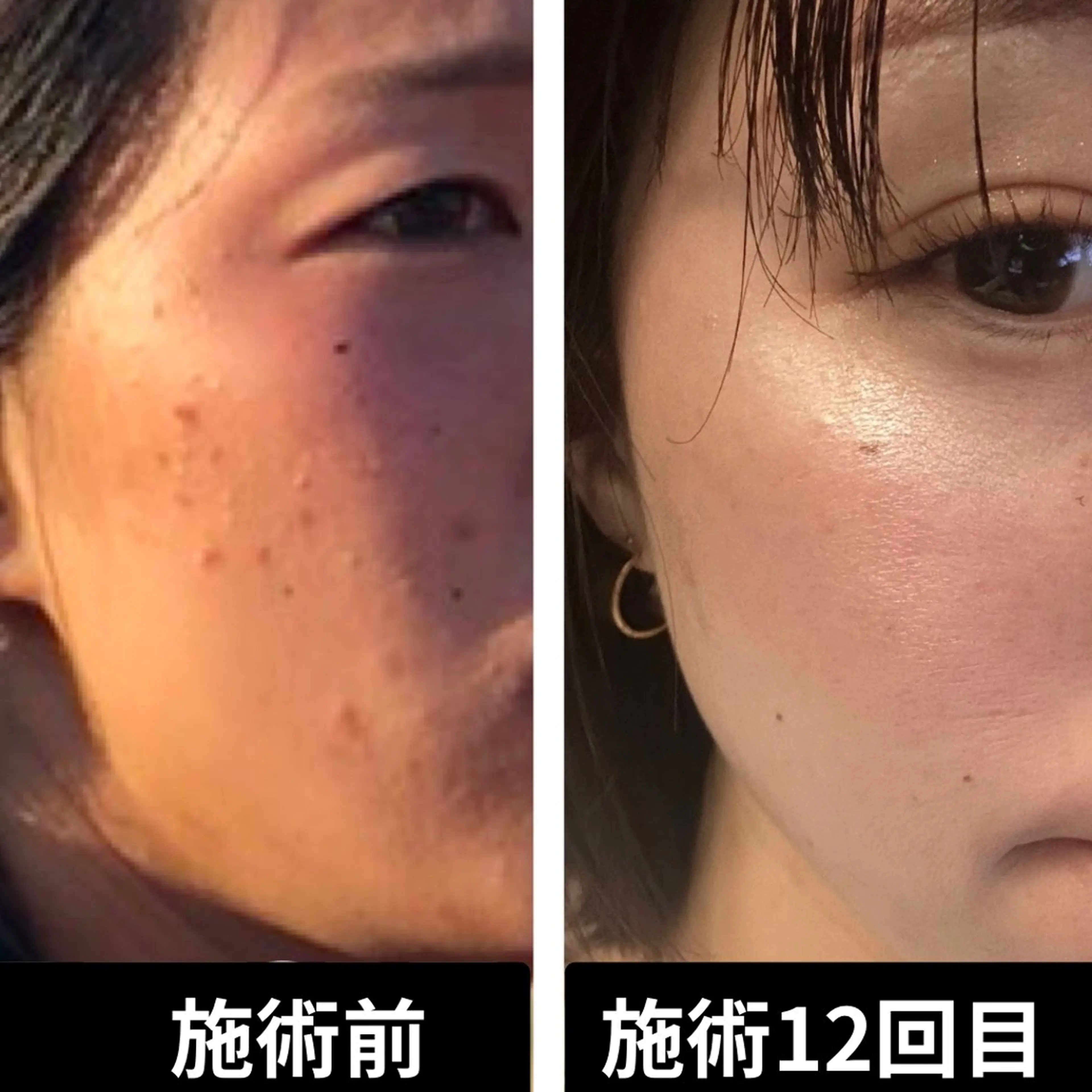 【最後のニキビケア】繰り返す大人ニキビを根本改善◎の写真