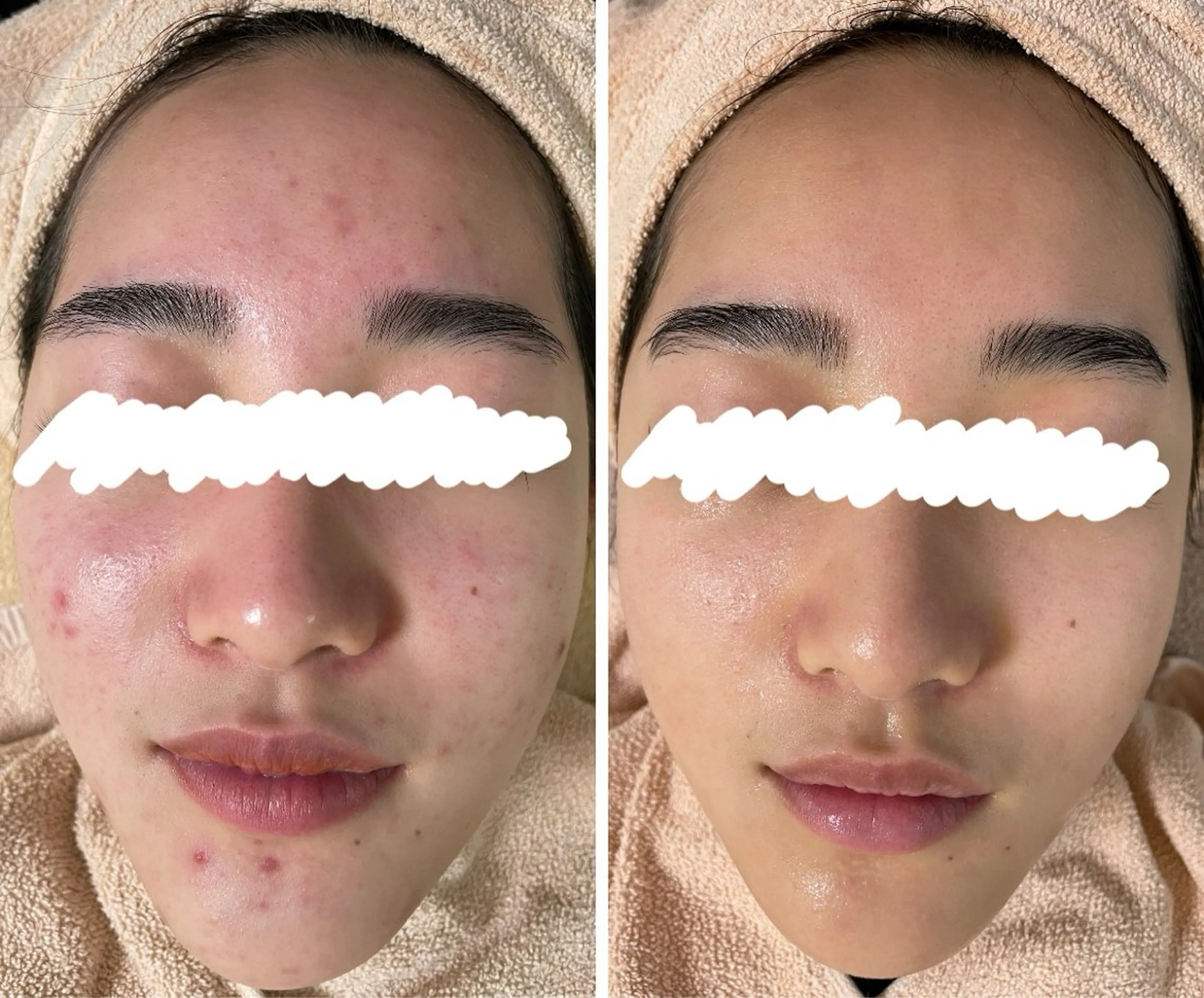 エステ ニキビ&跡改善サロン オーナー光木のエステ・リラクイメージ