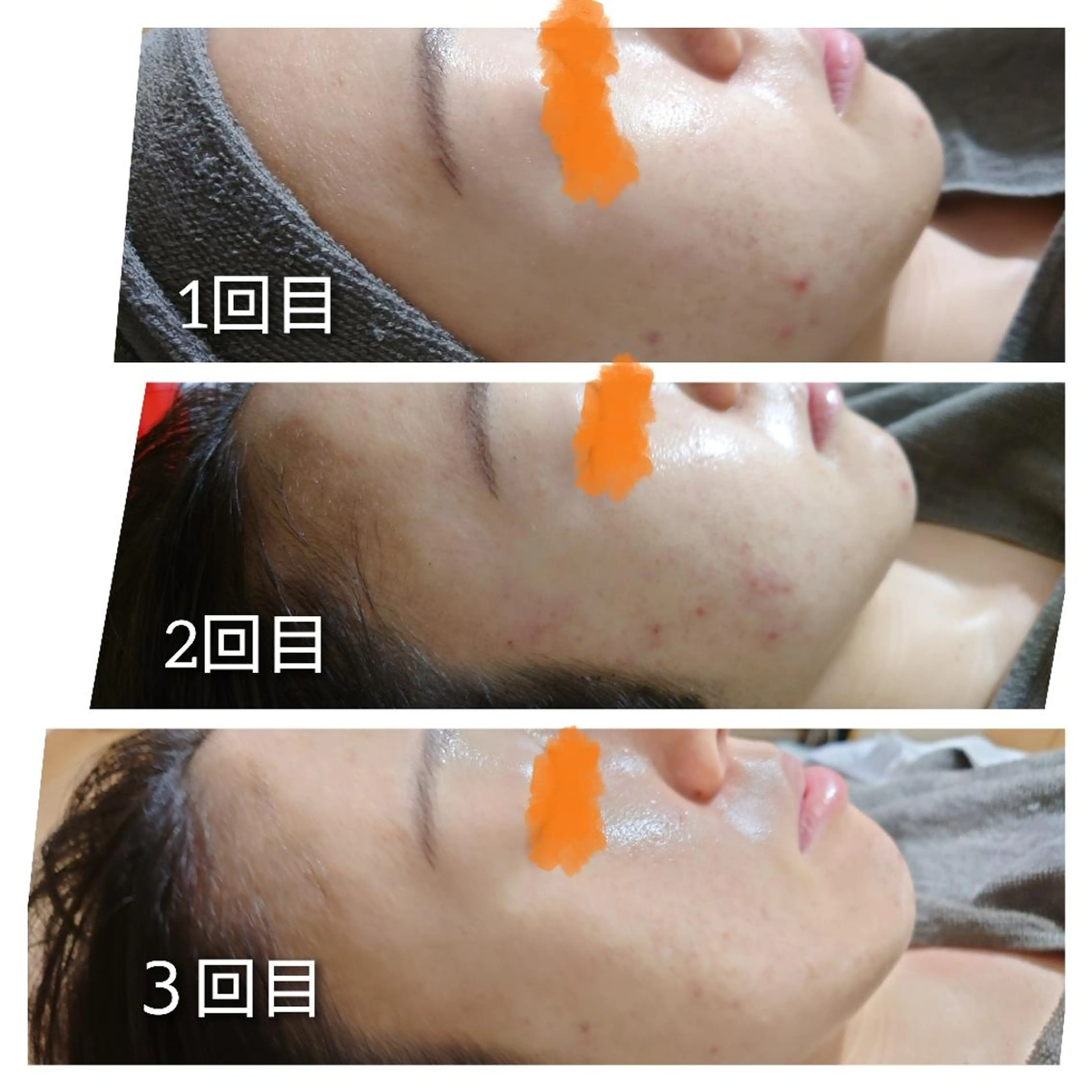 エステ Beauty Salon Luana所属・Luanaまつパ脱毛 ハーブピーリング眉毛のマツエク・マツパデザイン