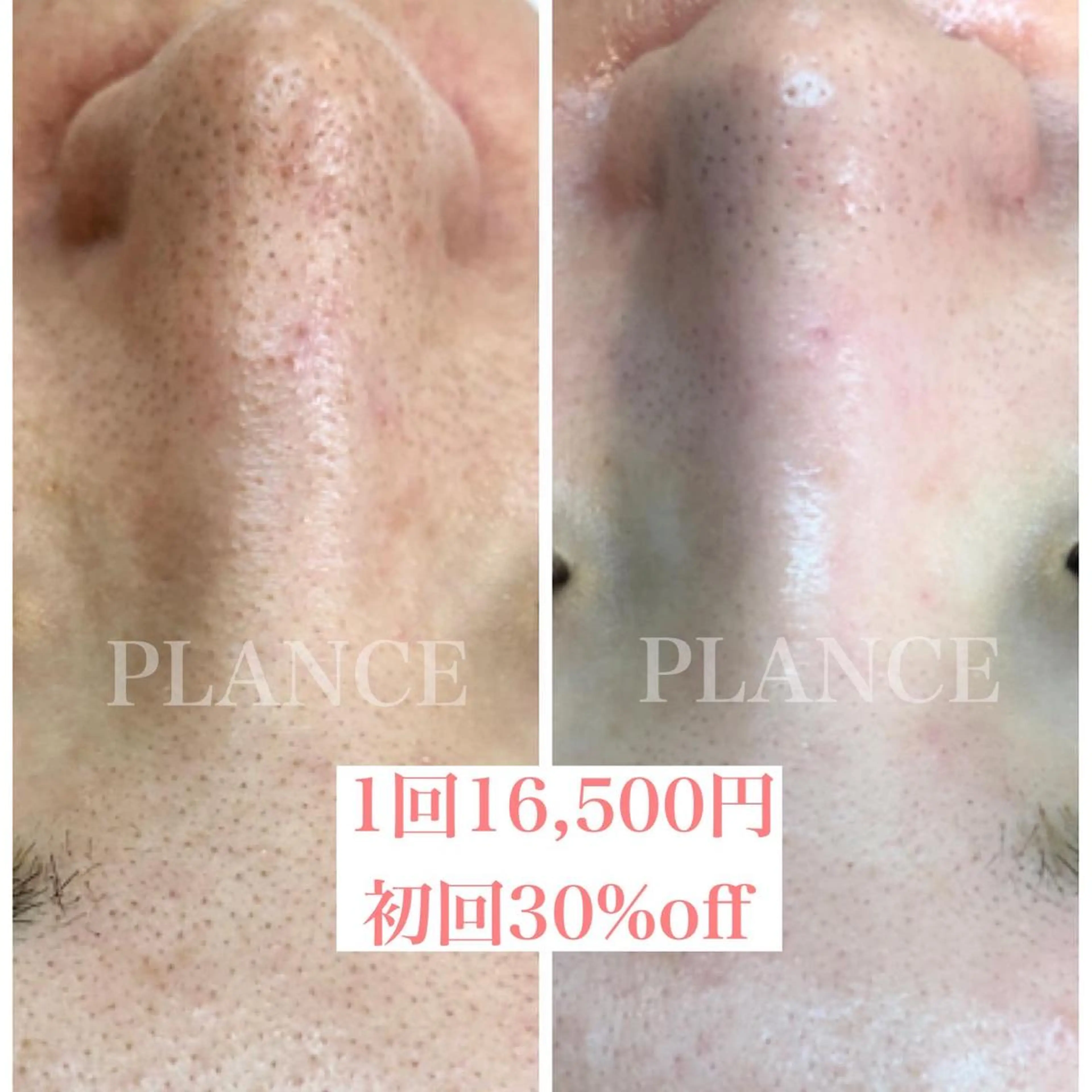 エステ フェイシャル専門 肌質改善/プランスのエステ・リラクイメージ