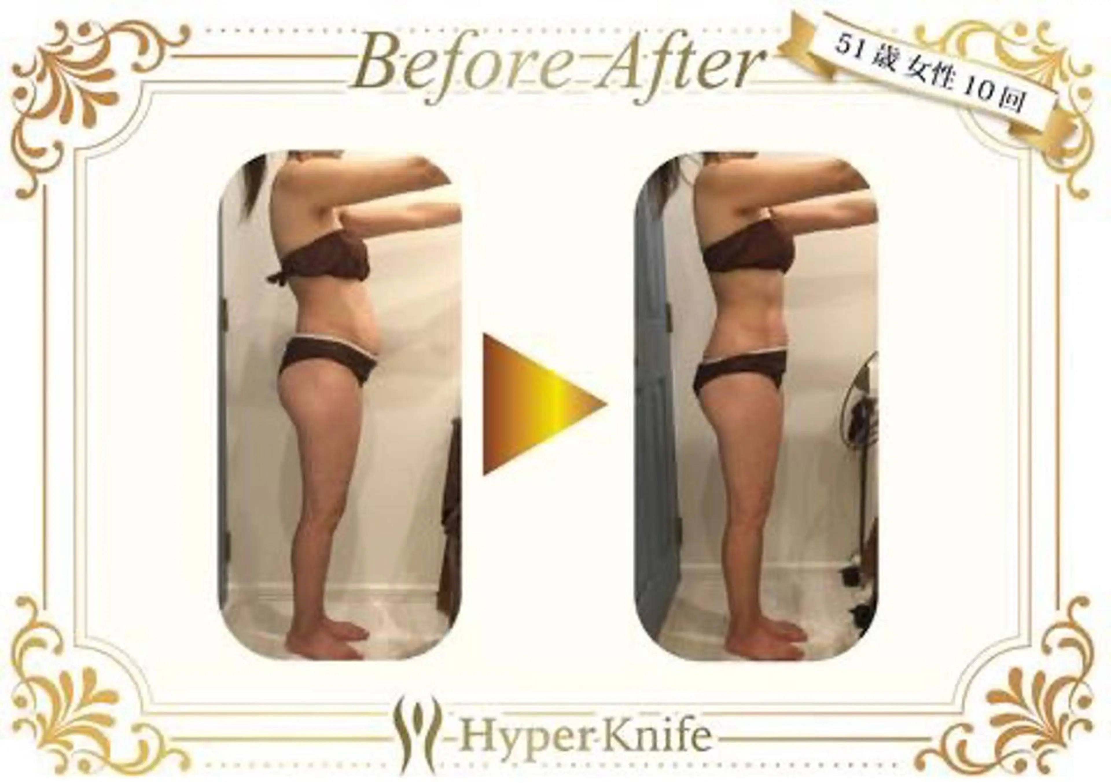 【人気No.1痩身】ハイパーナイフ6×アロマリンパ 70分の写真