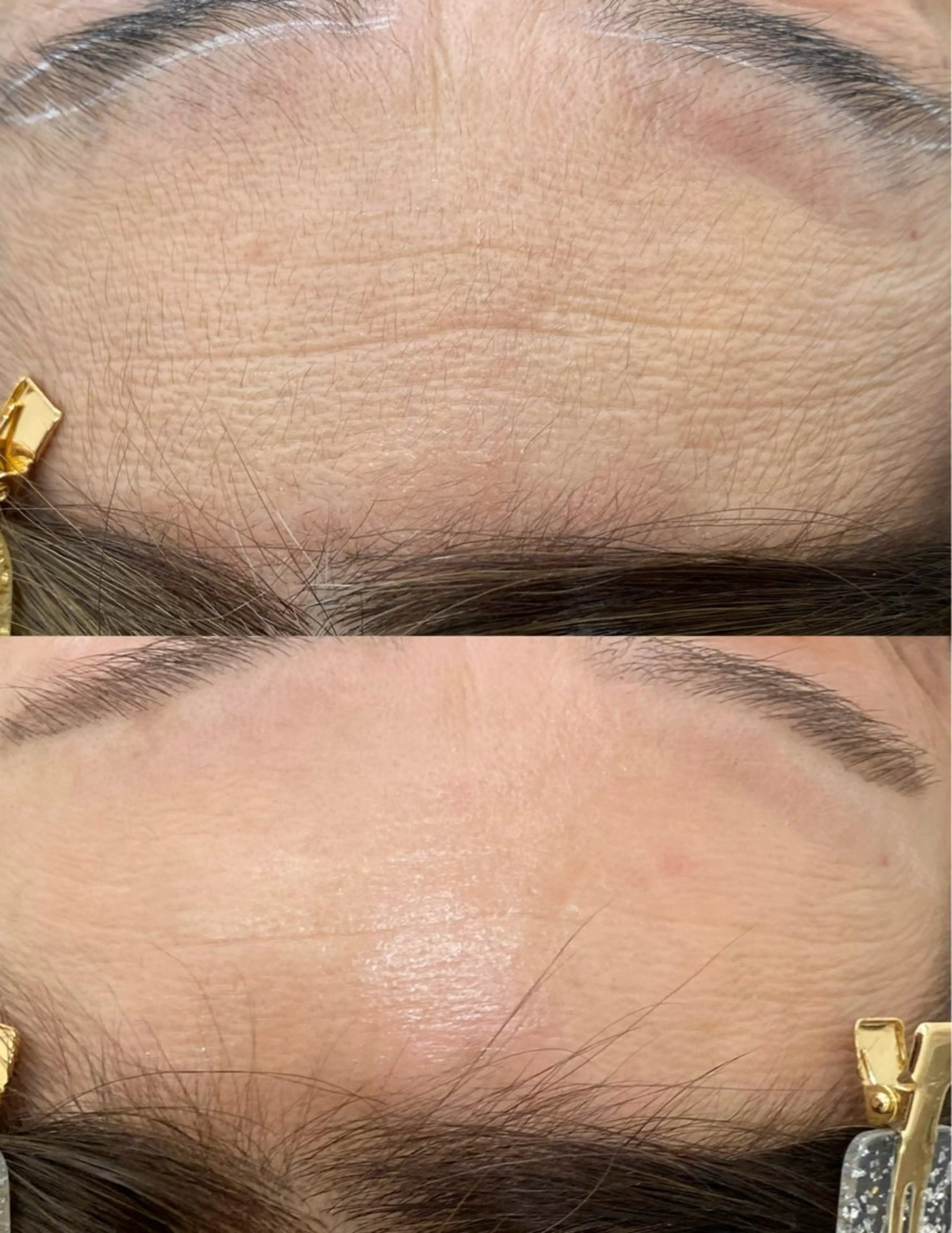 フェイシャル脱毛の写真