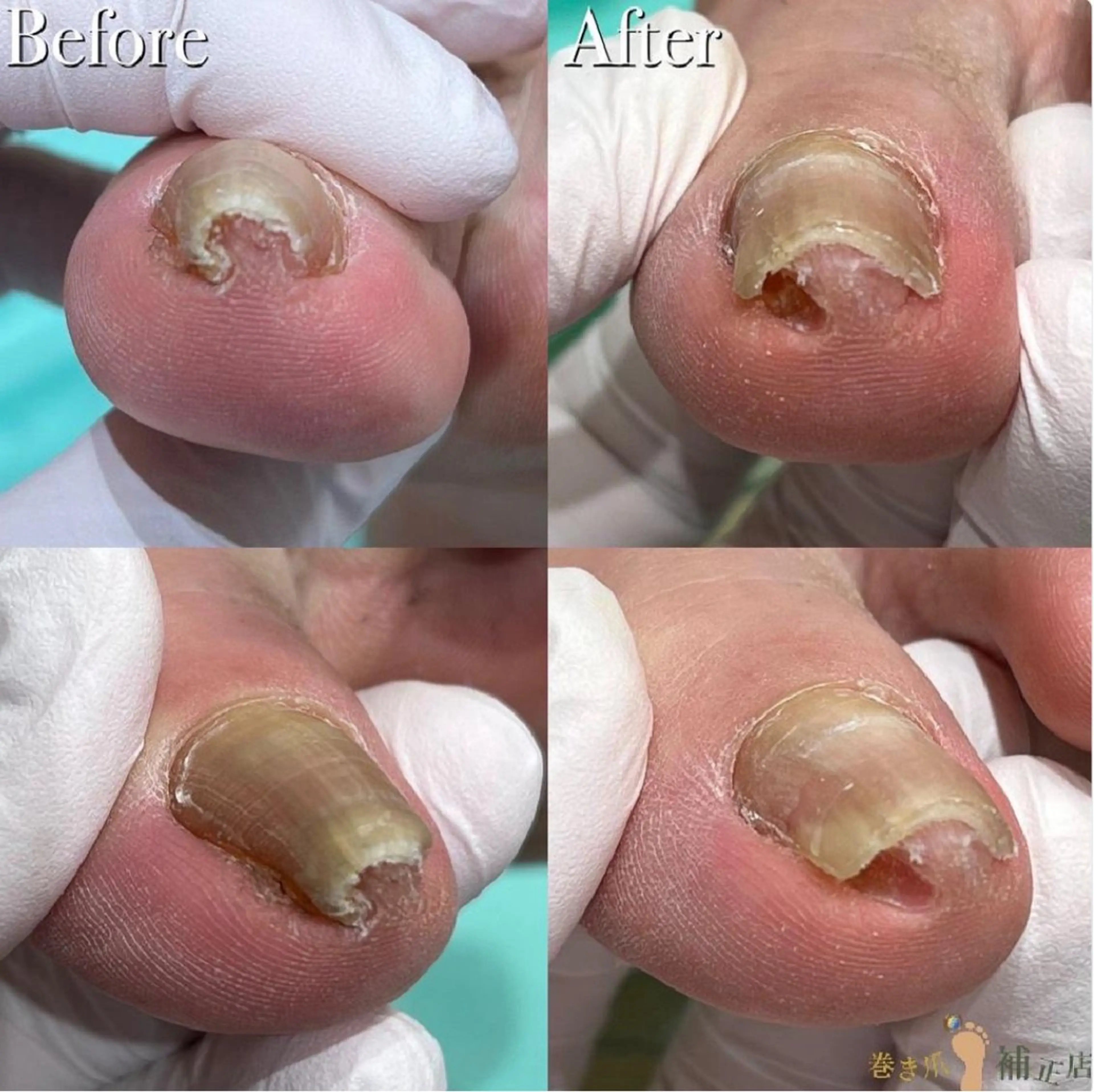 【巻き爪補正】1爪の巻き爪補正✨痛い💥巻き爪は早めのケアが大切💡形が気になる方もご相談ください💁‍♀️の写真