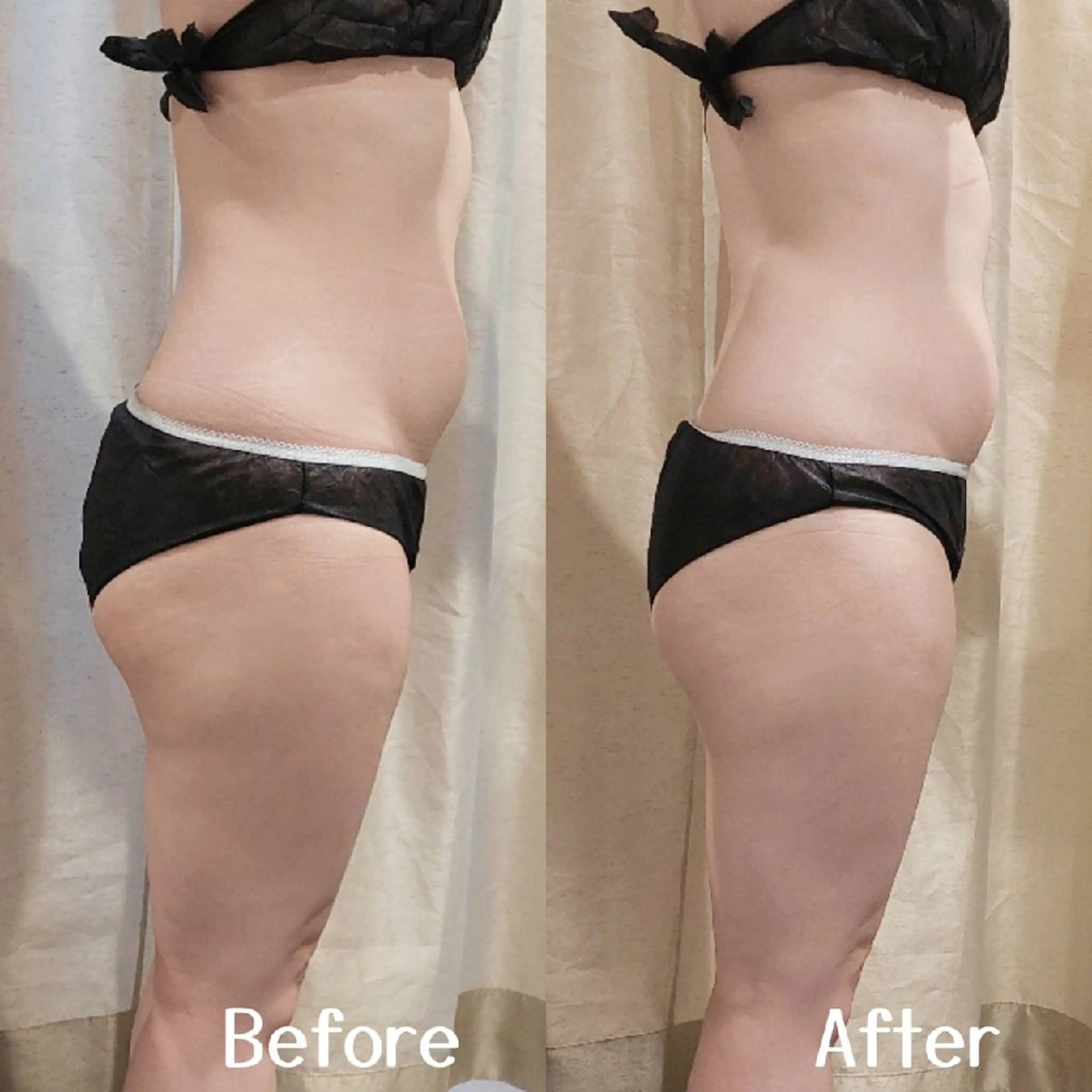 初回【ハイパーナイフ超!】お腹+腰回り集中★脂肪セル徹底ケア!ラフォス痩身の写真