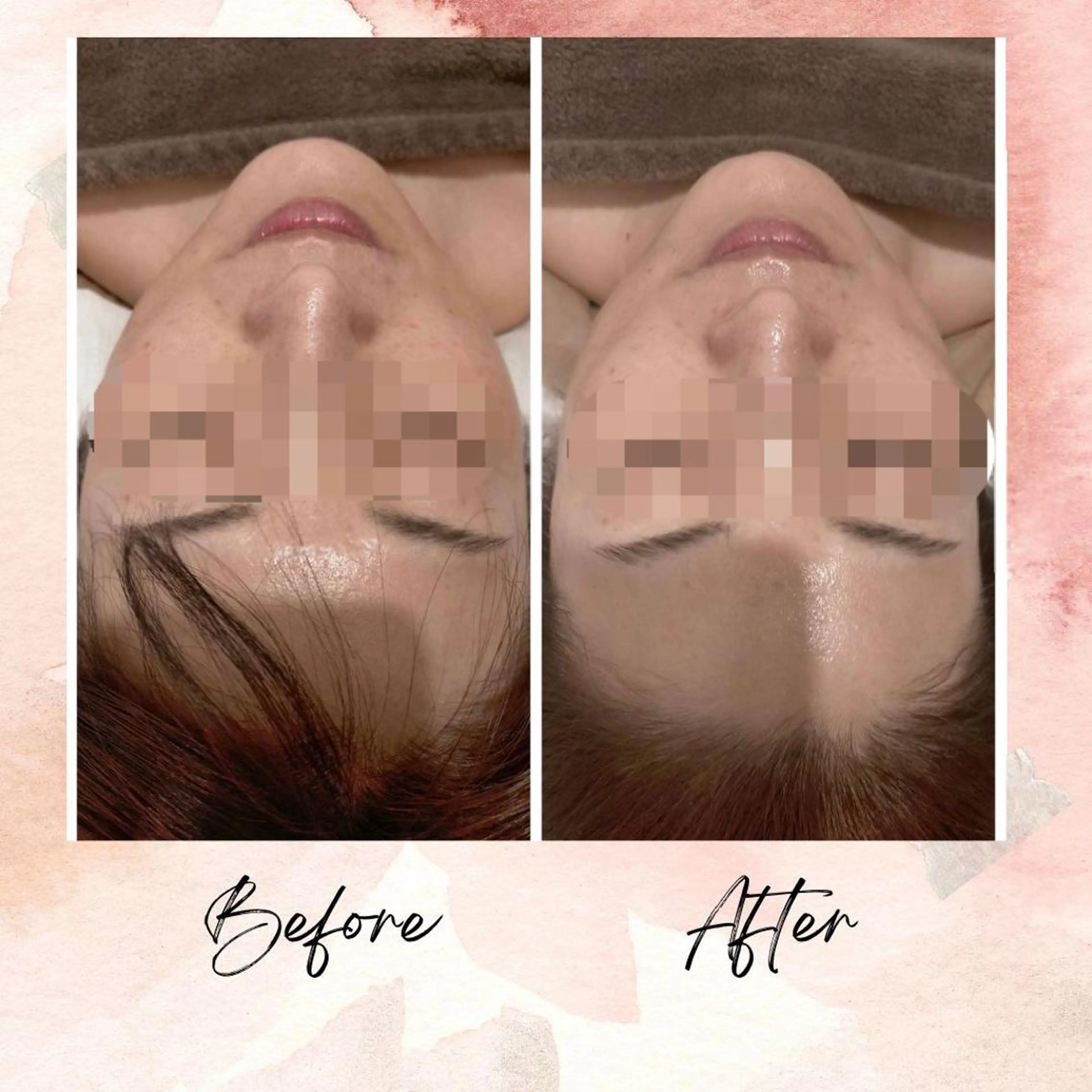 頭蓋骨小顔矯正モニター 1〜6回まで 60分の写真