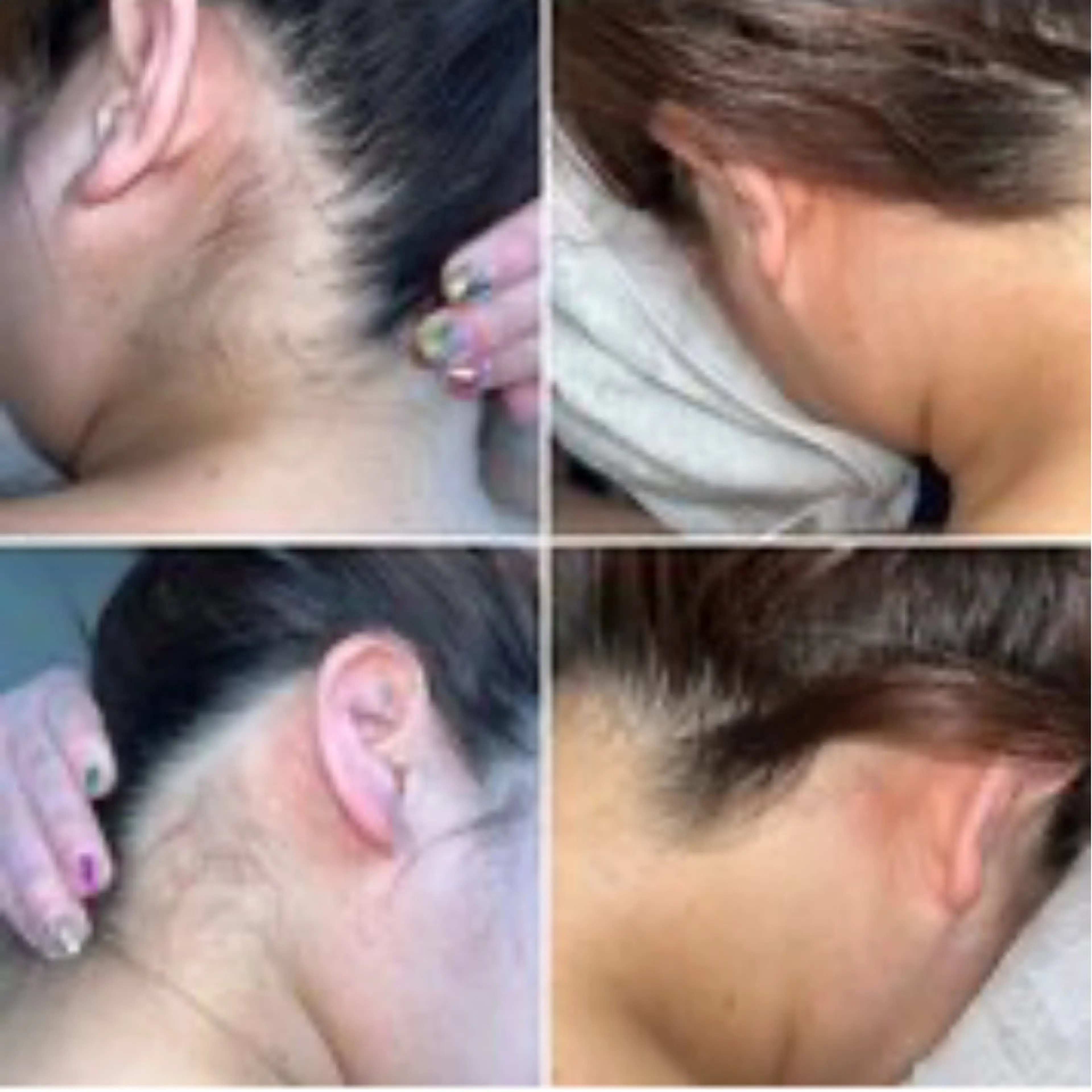 ［うなじ美人ワックス脱毛］夏に向けてアップスタイルを楽しみたい方、ショートヘアの方などかなり垢抜けたうなじ美人に☺️の写真