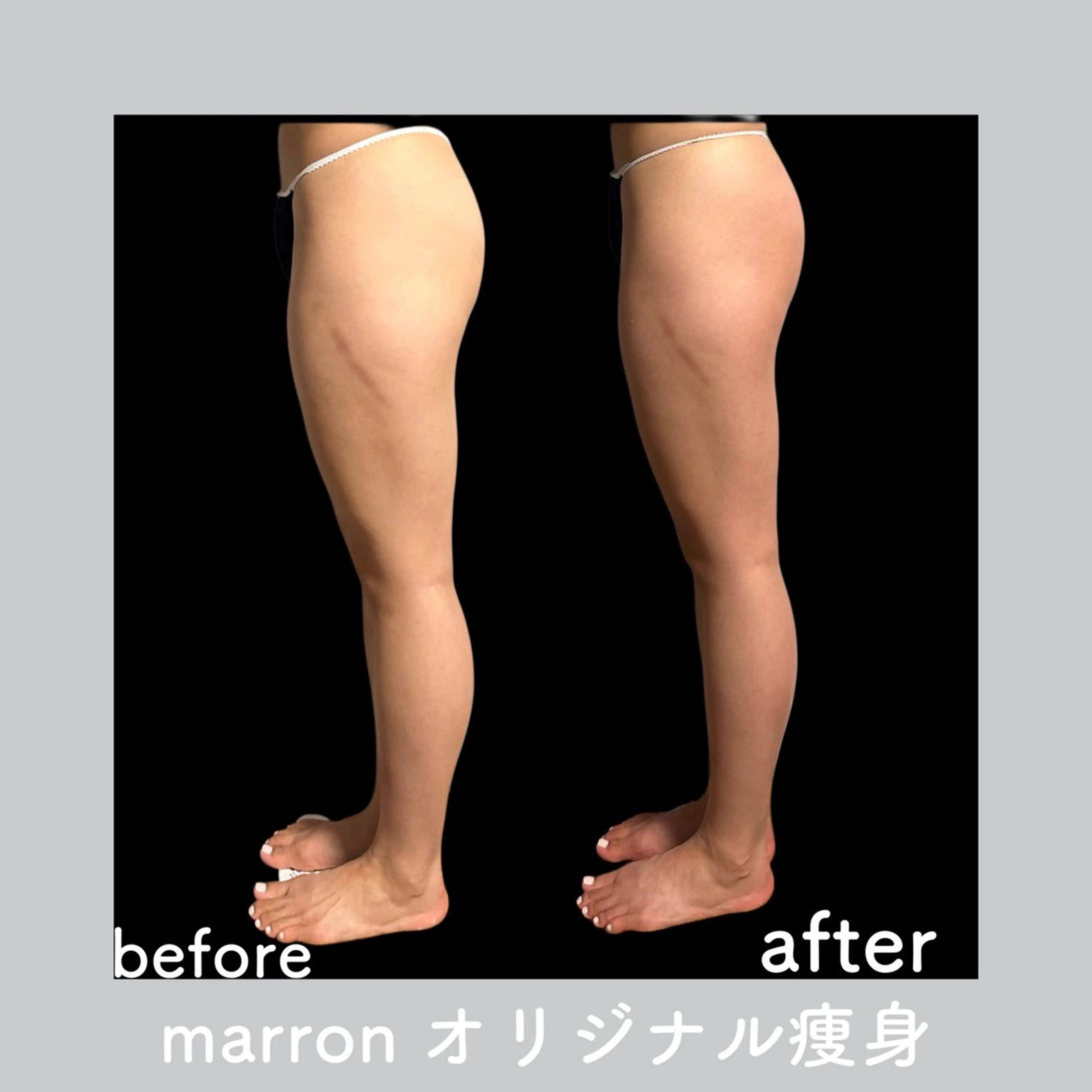 痩身ハイパーナイフ ララピールリアボーテのエステ・リラクイメージ