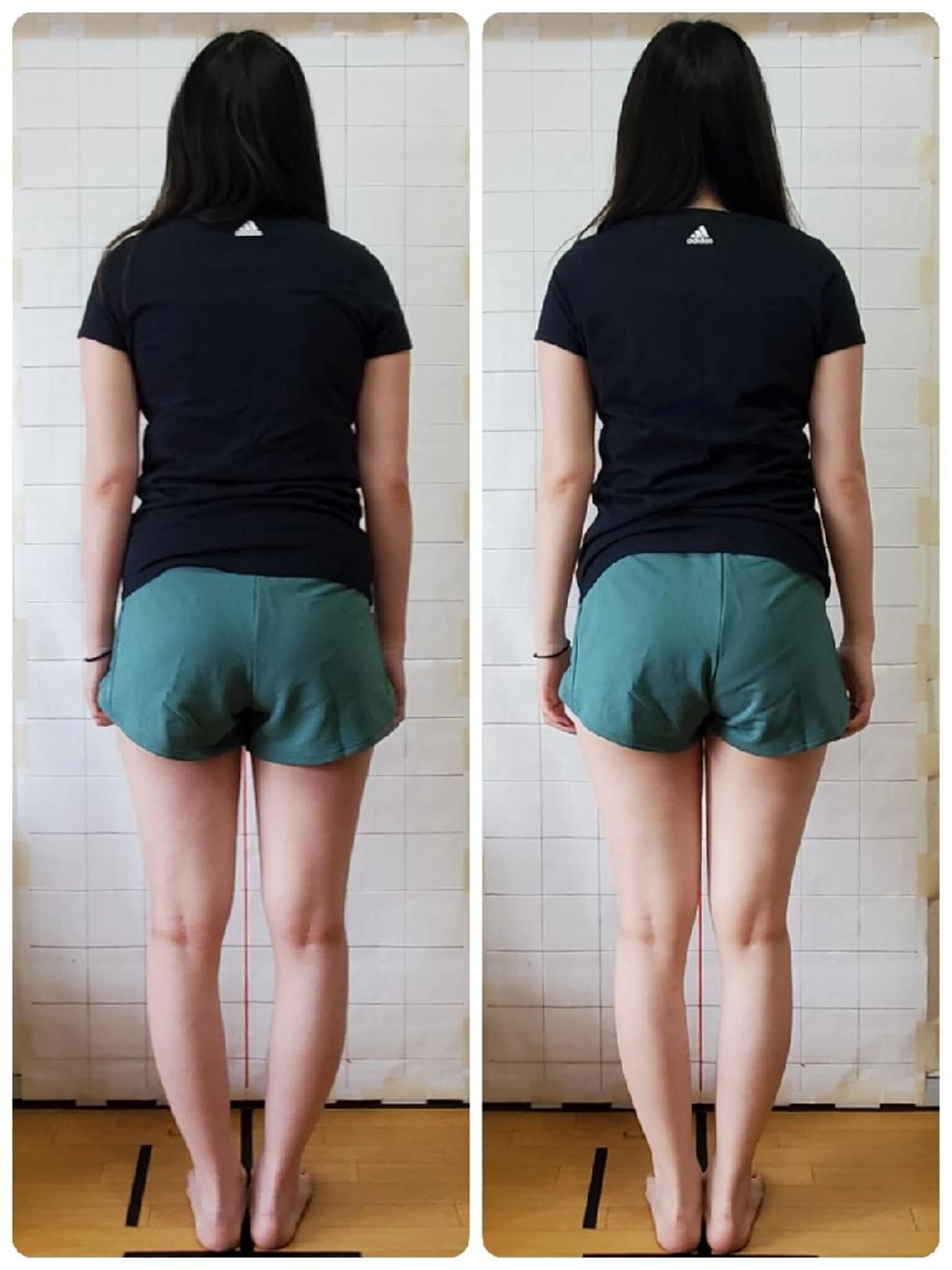 お試し美容整骨の写真