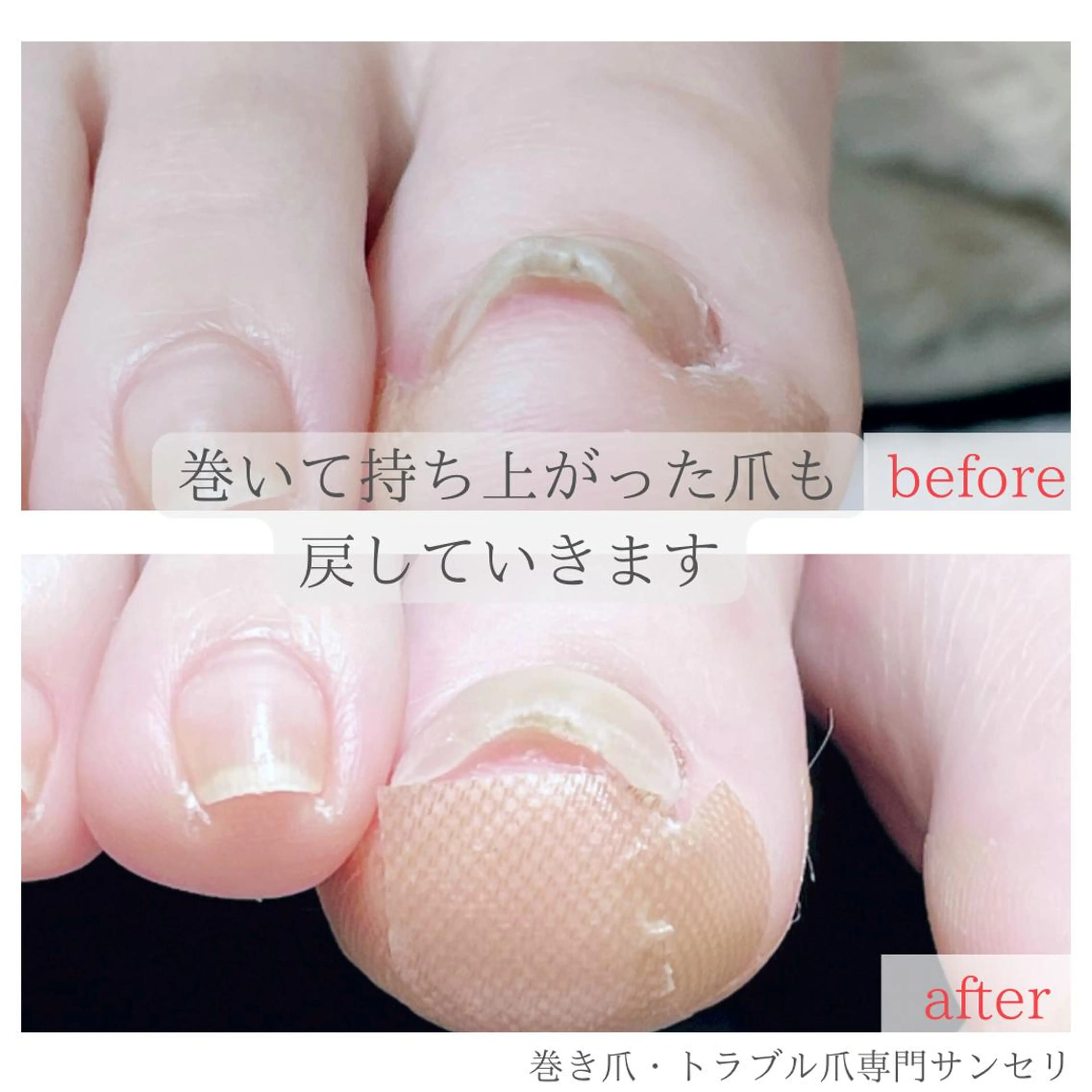 ネイル 深爪・巻き爪 専門サンセリテのネイルデザイン