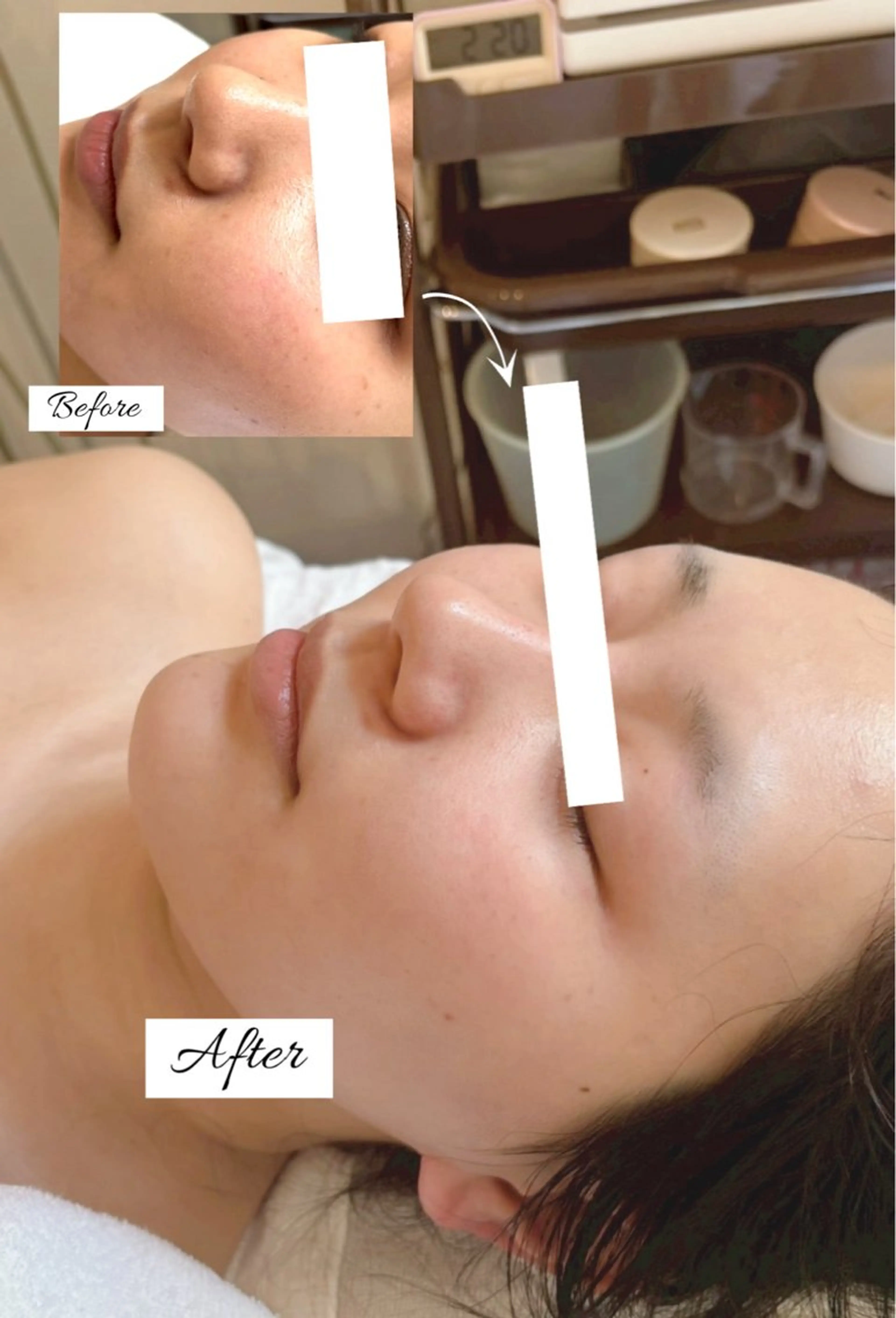 エステ 心斎橋🤍毛穴洗浄/ ピーリング/POLAのエステ・リラクイメージ