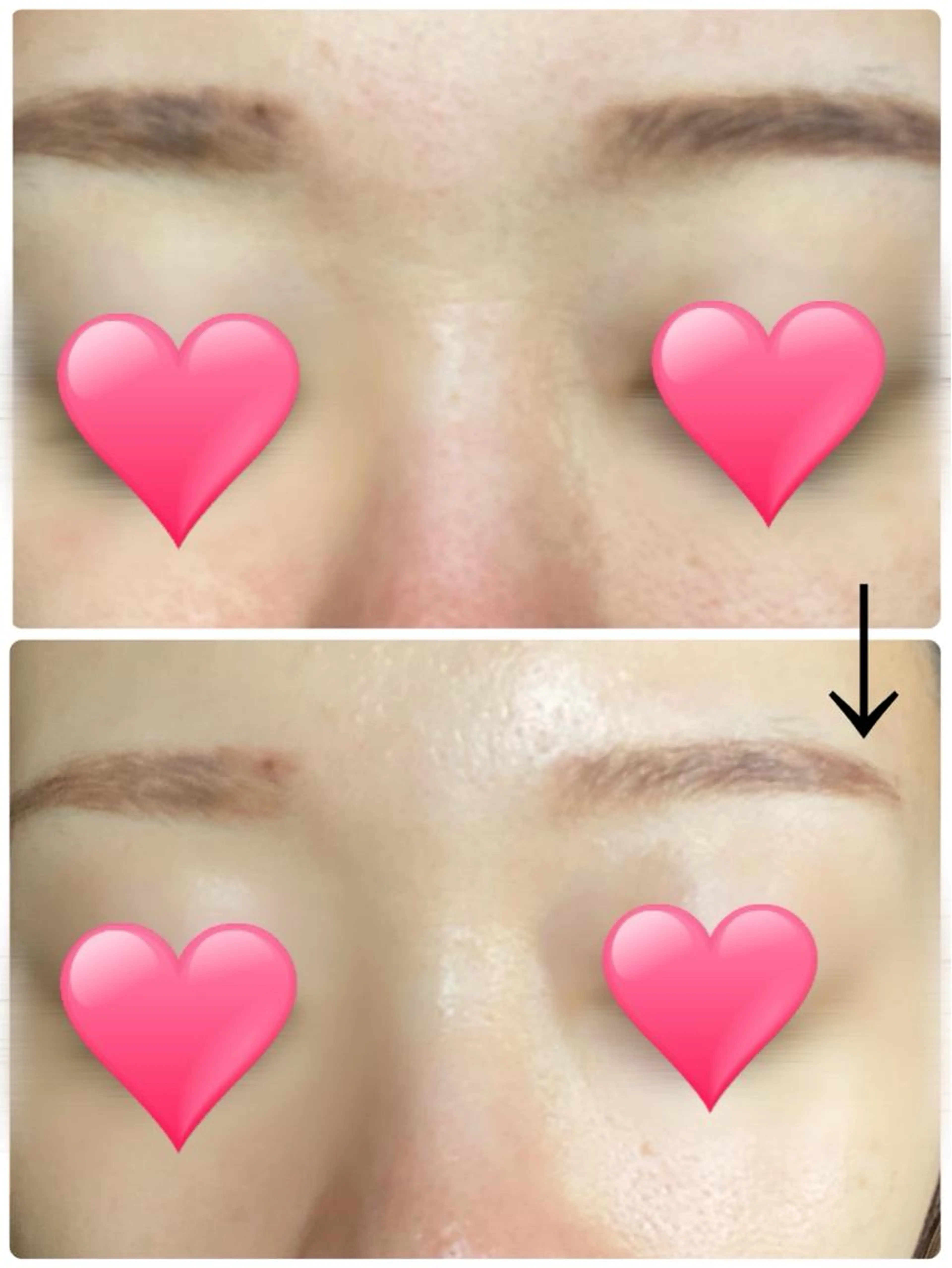 韓国肌人幹細胞炭酸パックエステ💆🏼‍♀️の写真