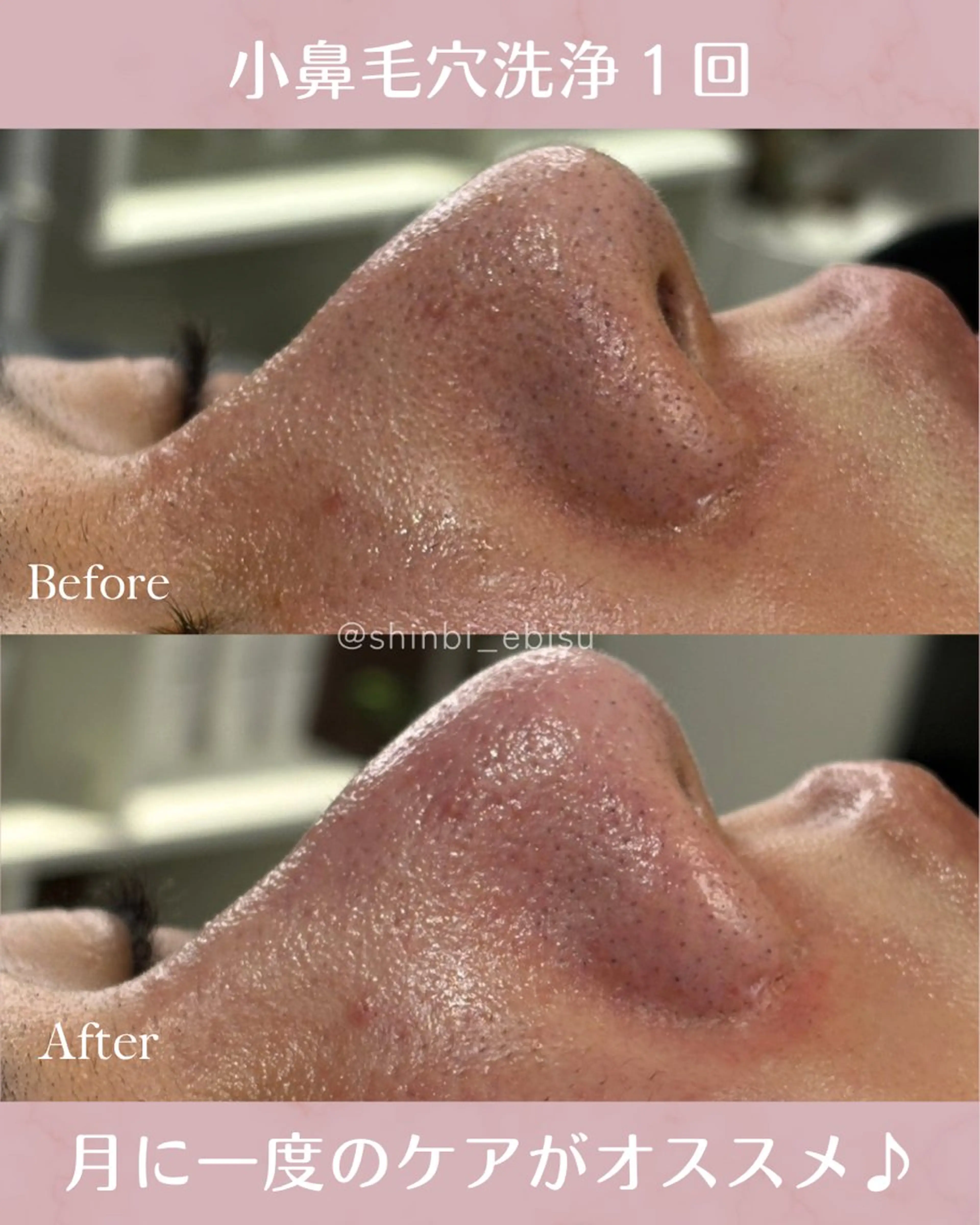 エステ 毛穴・ニキビケア ￤肌質改善￤EMIのエステ・リラクイメージ