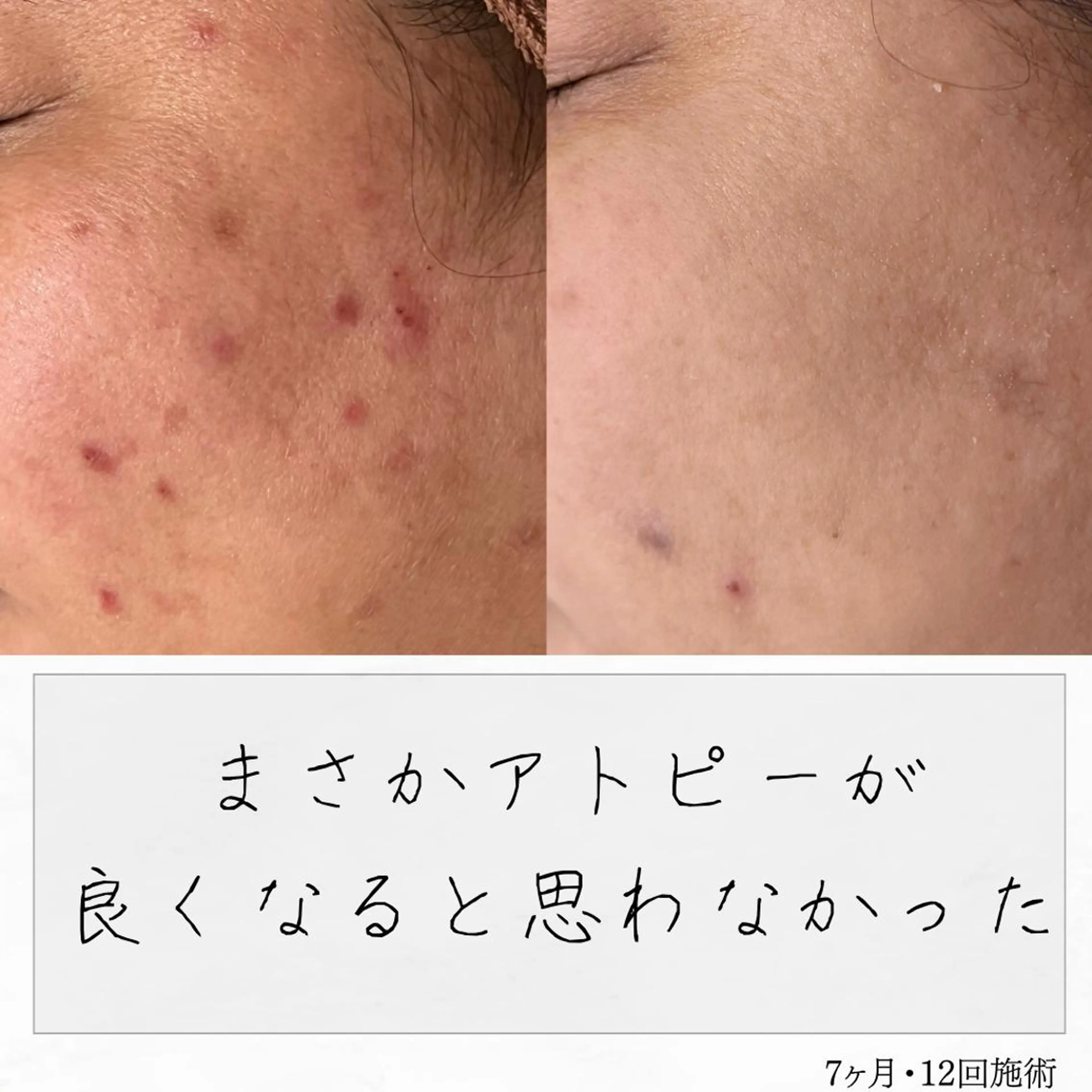 ニキビ経験者が施術 する専門サロン🌻のエステ・リラクイメージ