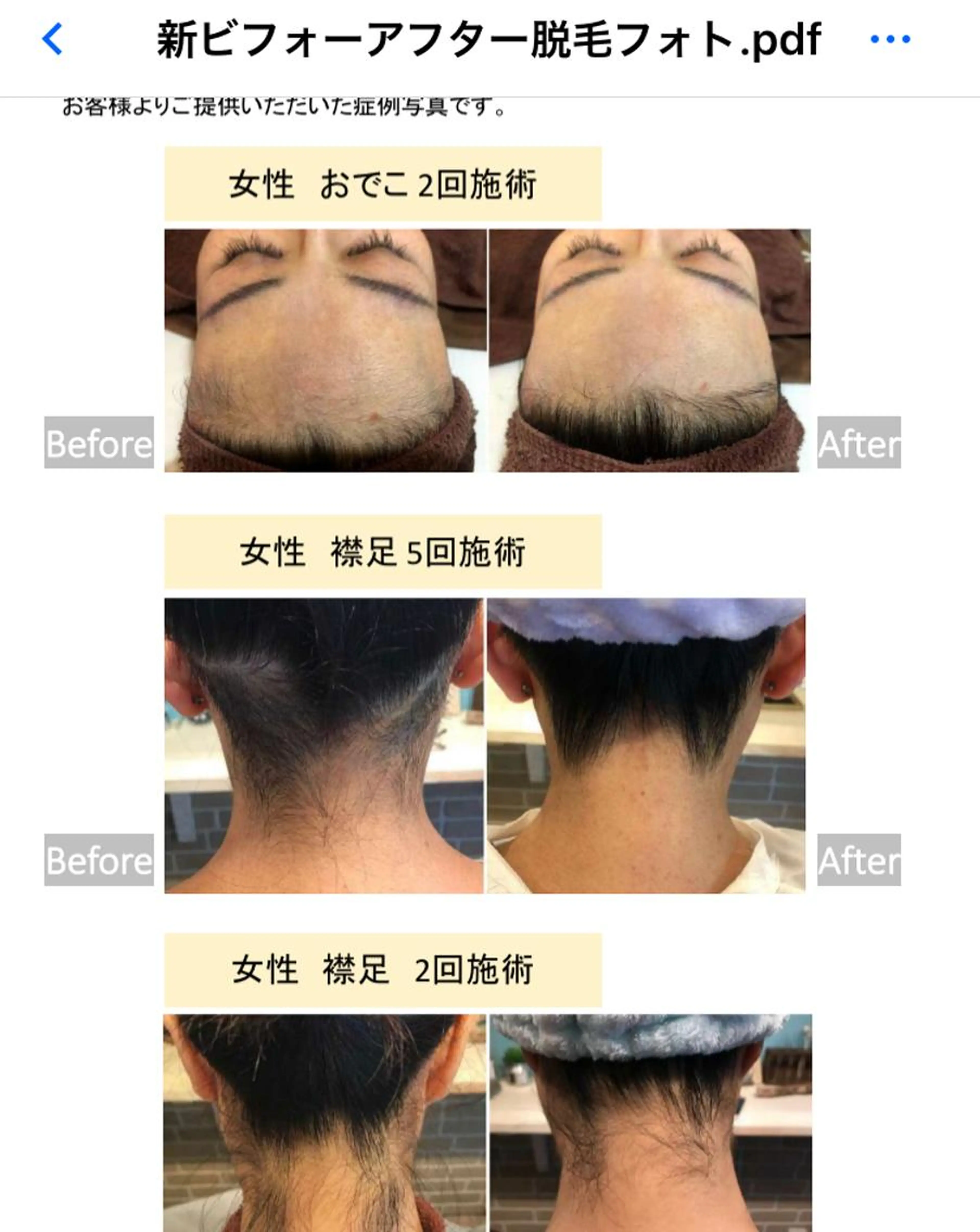 女性限定 全身脱毛(VIO込顔なし)の写真