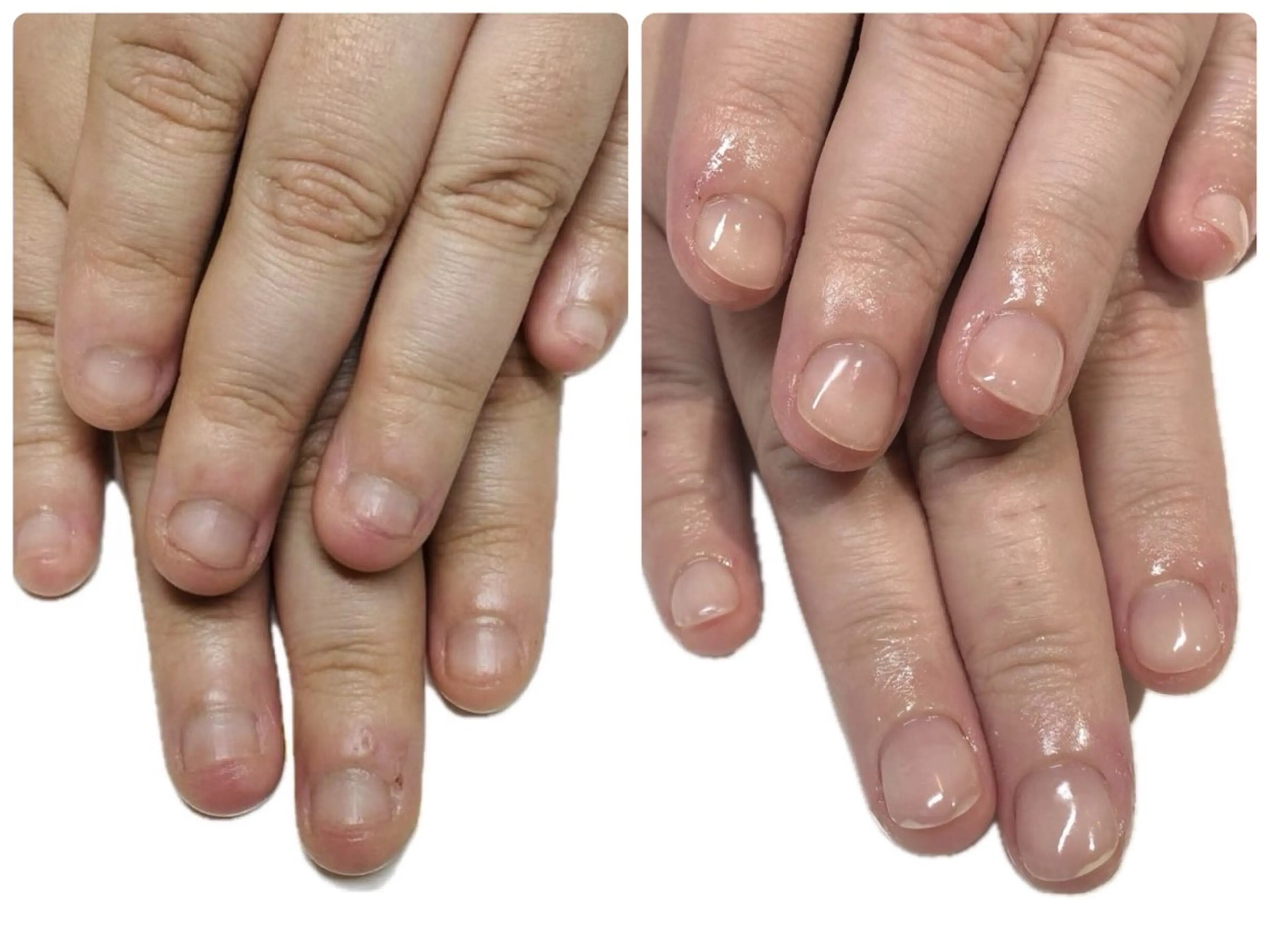 ネイル 深爪矯正・自爪育成 ヴェールリムのネイルデザイン