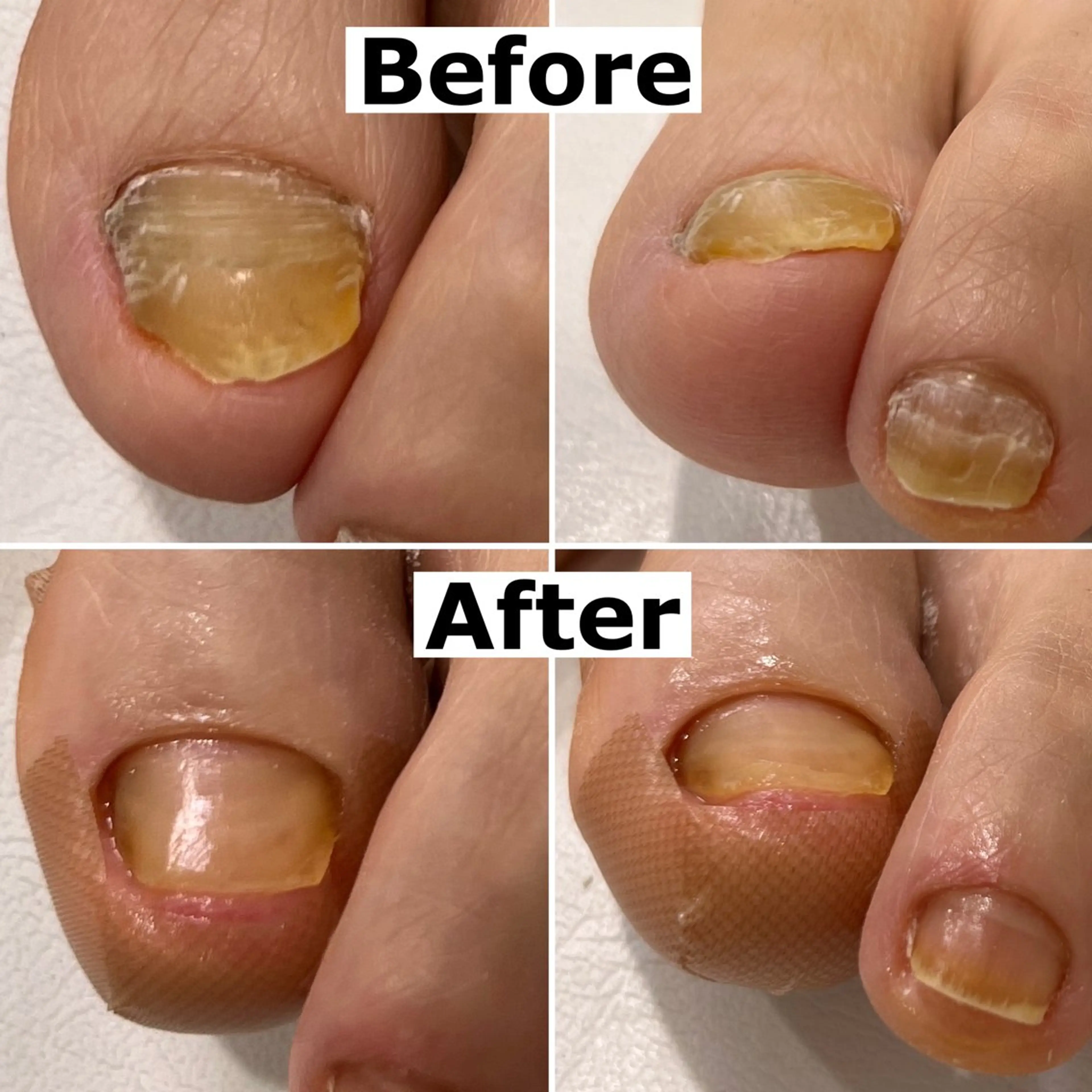 ネイル 巻爪無料モデル募集 ✨🦶MEGUMIのネイルデザイン