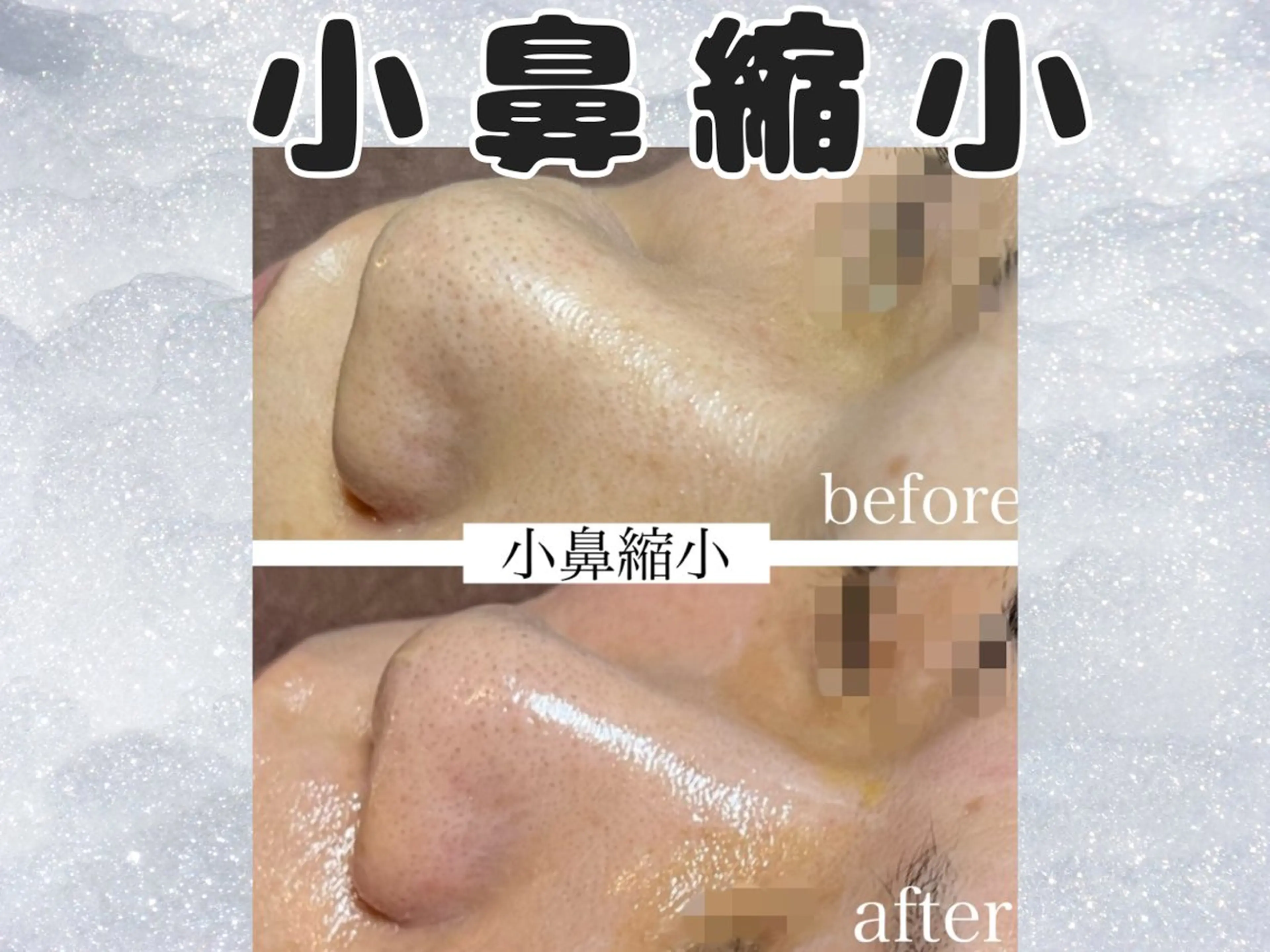 小鼻縮小ケア★幹細胞水光肌リフティング付きの写真