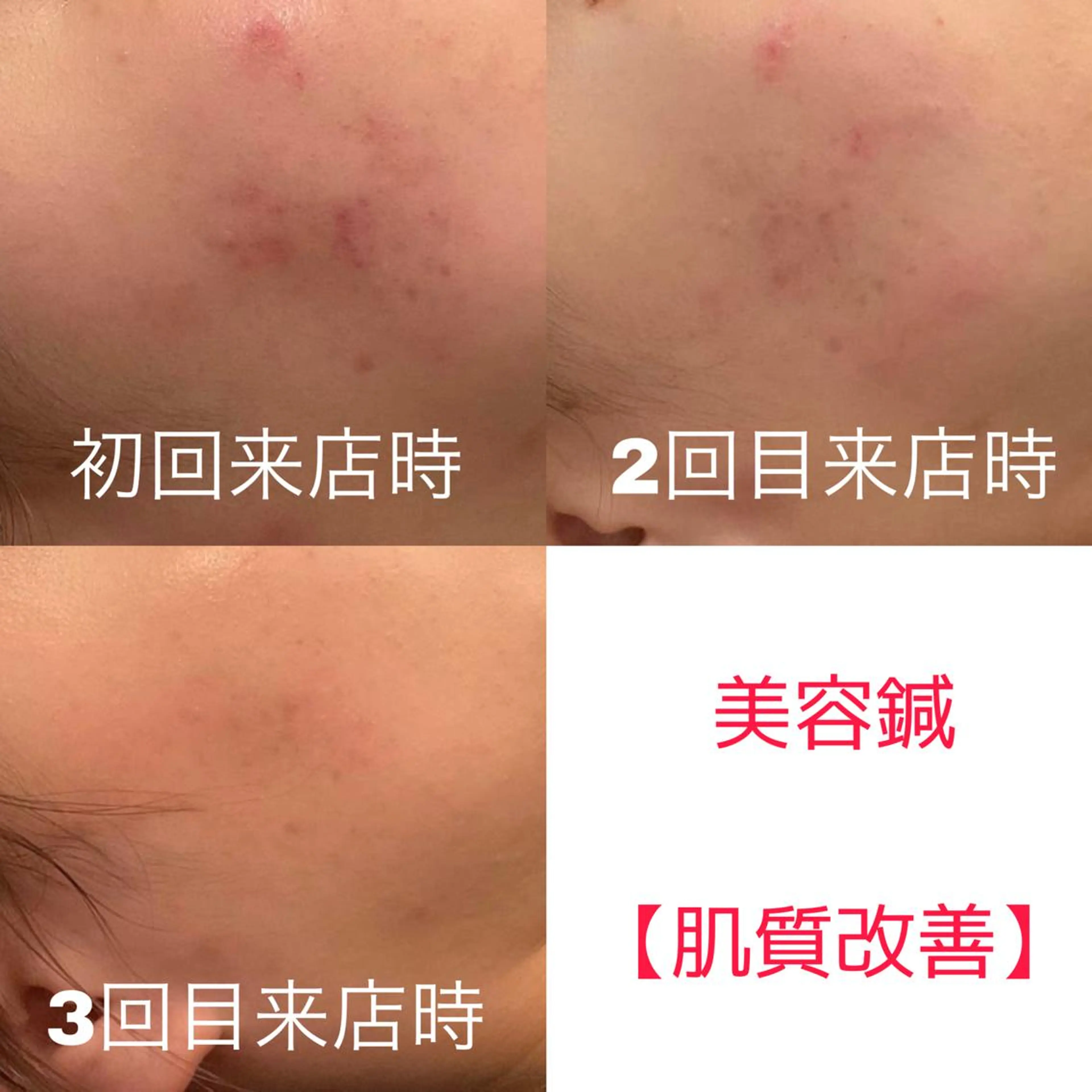 ☀️おすすめNo,3☀️【肌荒れ改善特化メニュー】W美容鍼（40本）＋ヘッドマッサージ＋首肩背中マッサージの写真