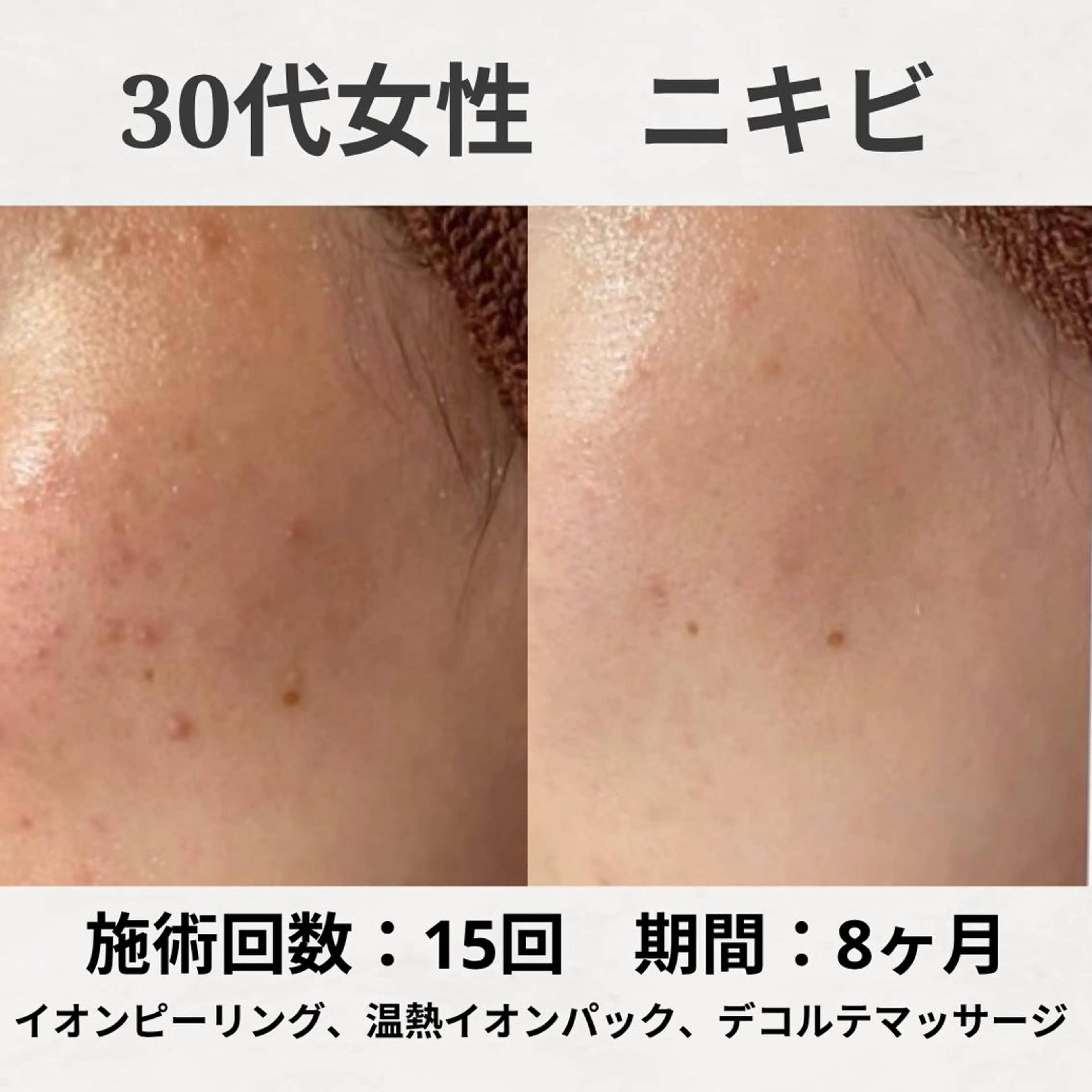 エステ リラク ニキビ跡改善専門🔥 医療にはできない改善のエステ・リラクイメージ