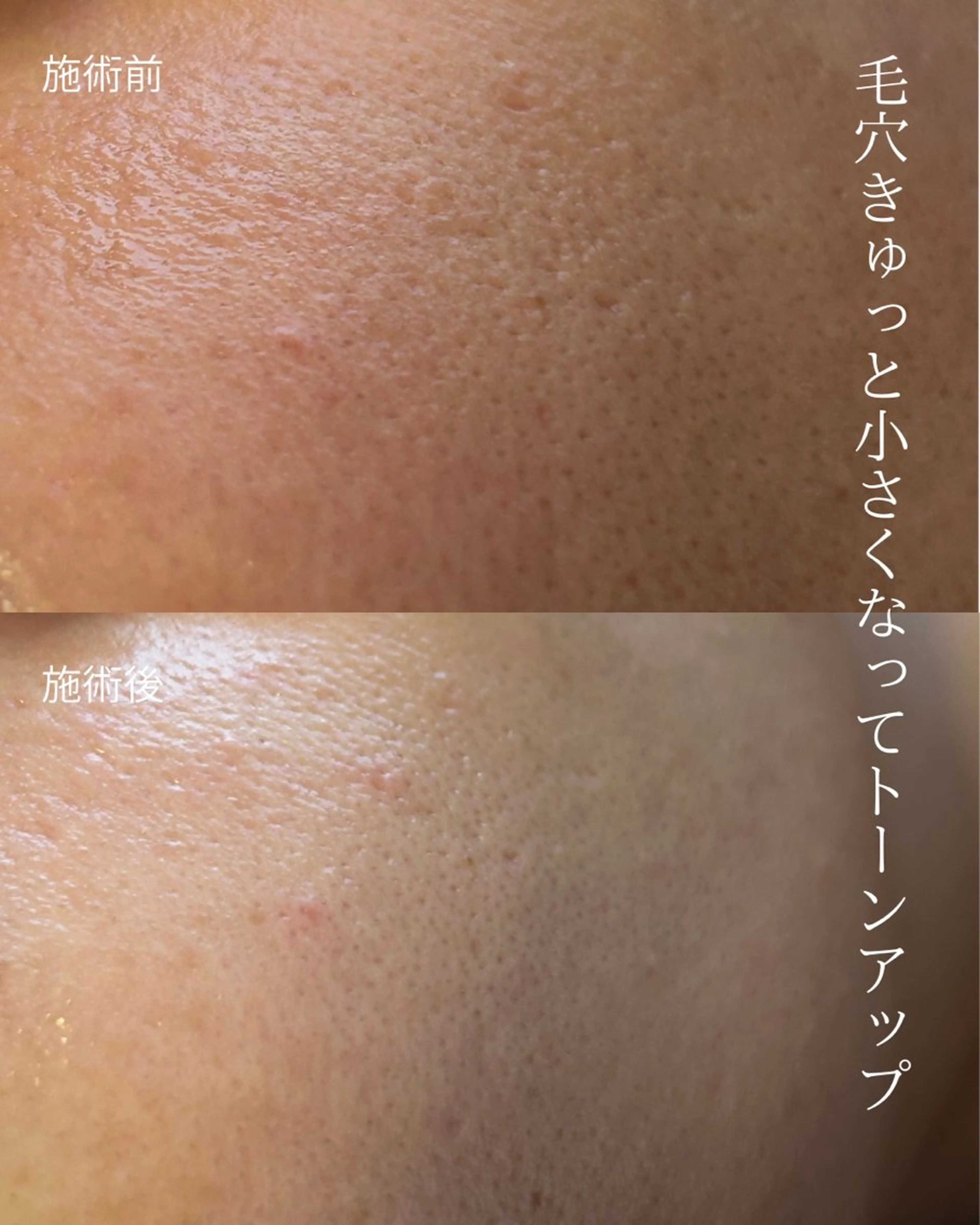 たるみ毛穴ケアコース 【5月まで新生活応援📣キャンペーン中】の写真