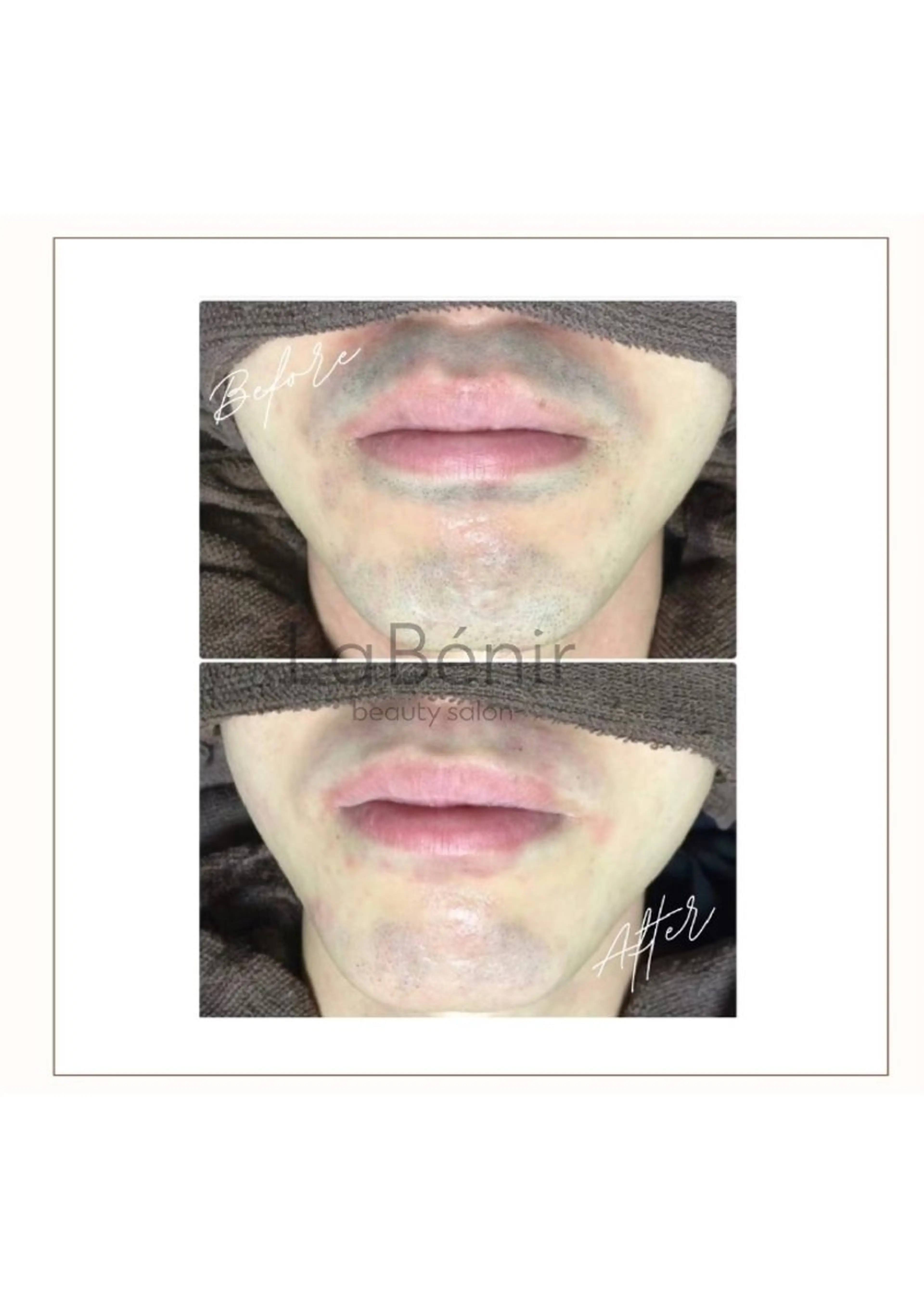 エステ 脱毛/美肌【皮膚科看 護師経営】ラベニールのエステ・リラクイメージ