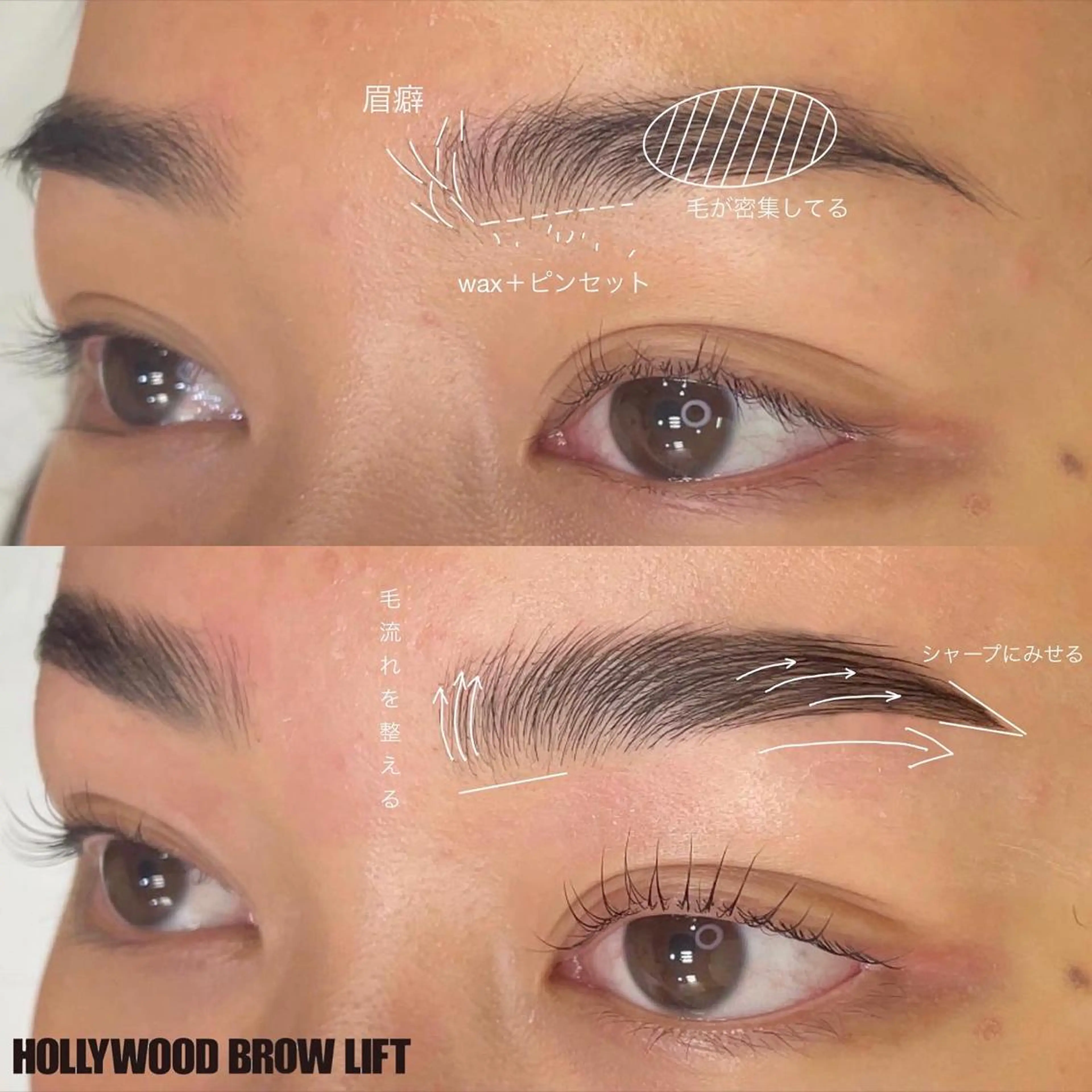 ハリウッドブロウリフト（HBL）の写真