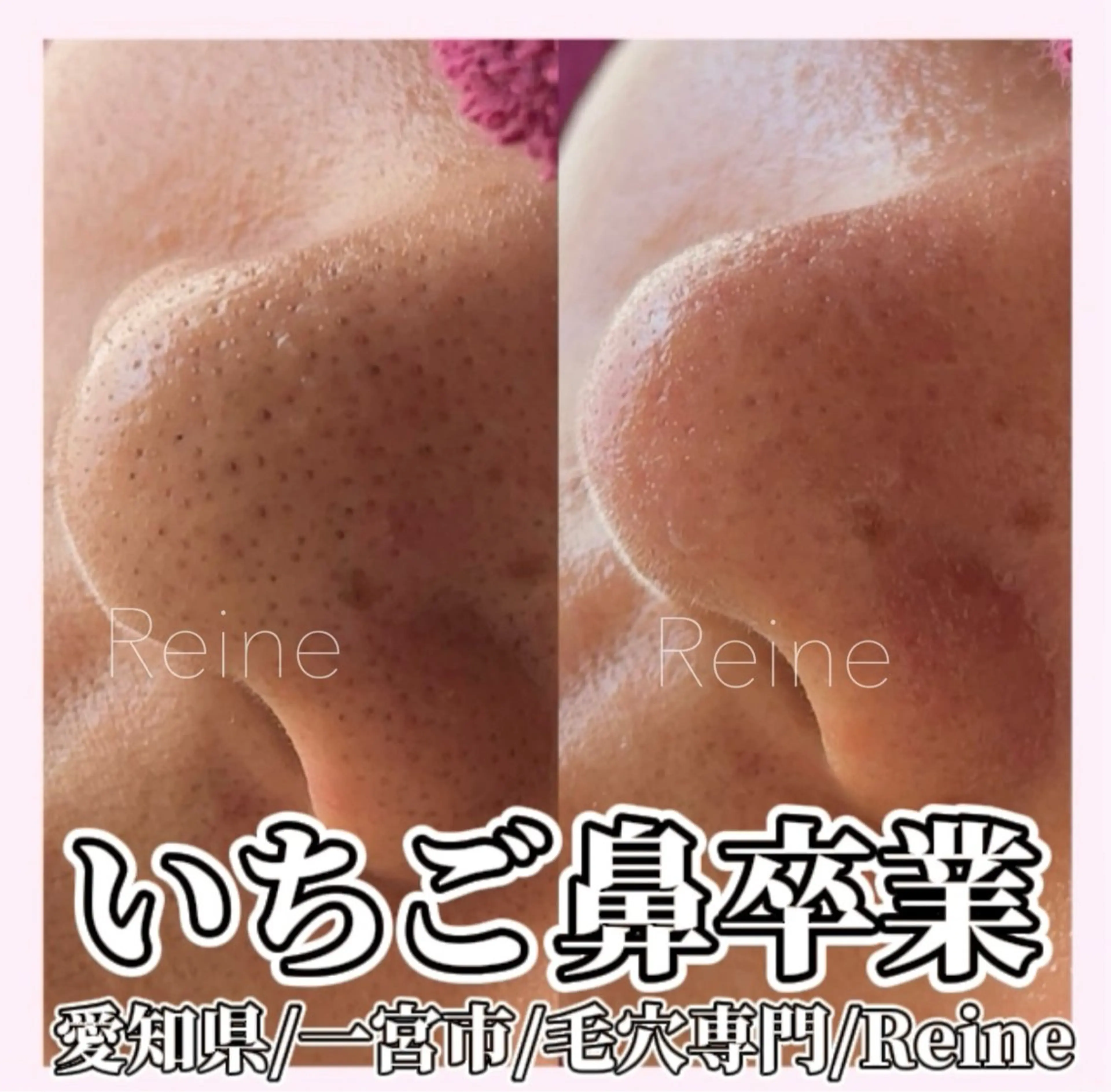 毛穴/シミ肝斑/脱毛 横山梨里のエステ・リラクイメージ